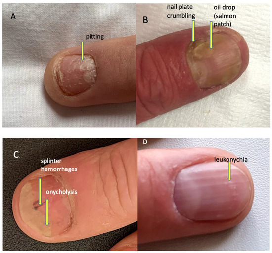 Pitted Nails as Sign of Psoriasis