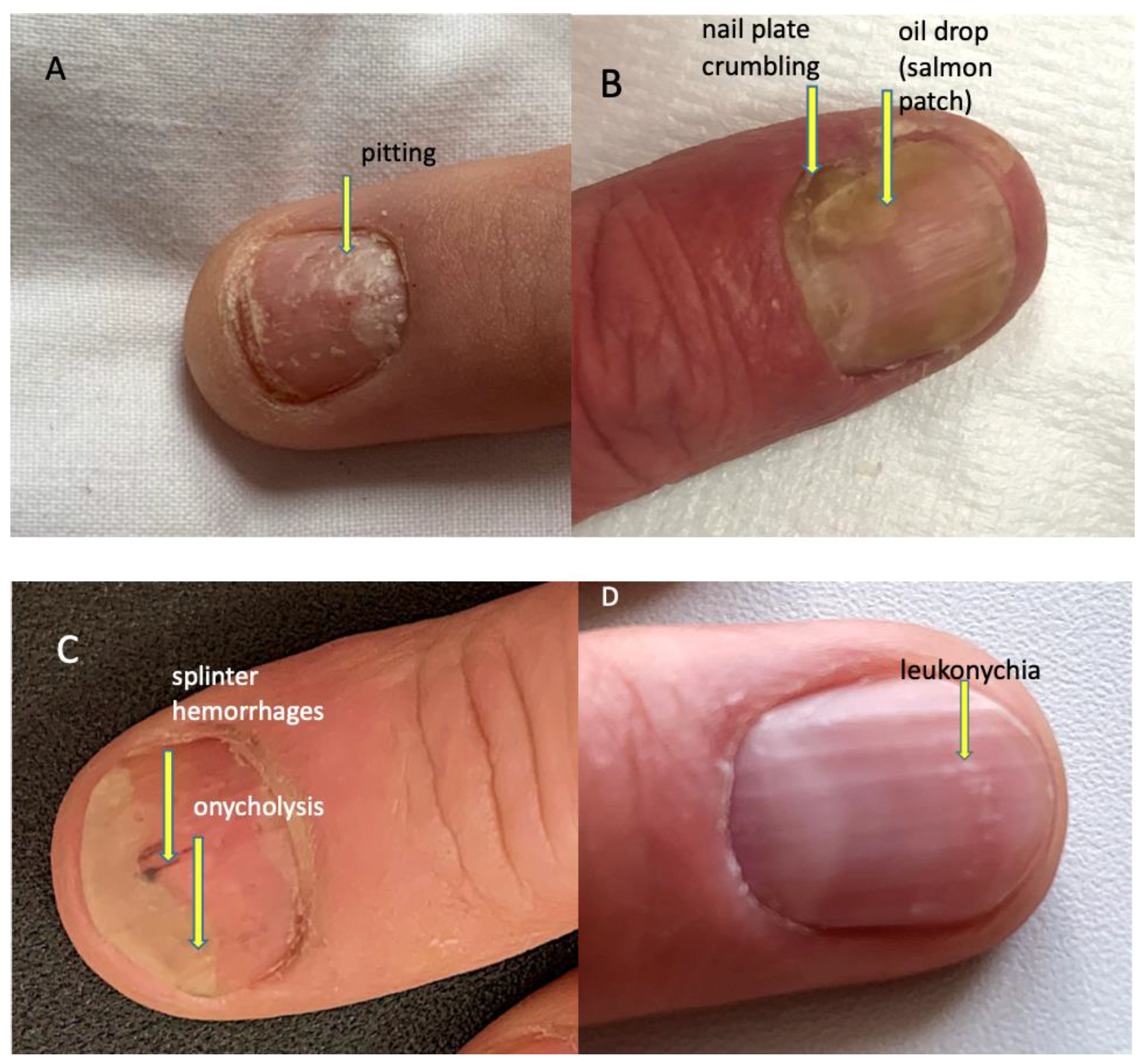 Onychomycosis or fungal nail infection on damaged nails after gel polish,  onychosis. Longitudinal ridging nails with psoriasis, nail diseases. Health  and beauty problem | Stock image | Colourbox