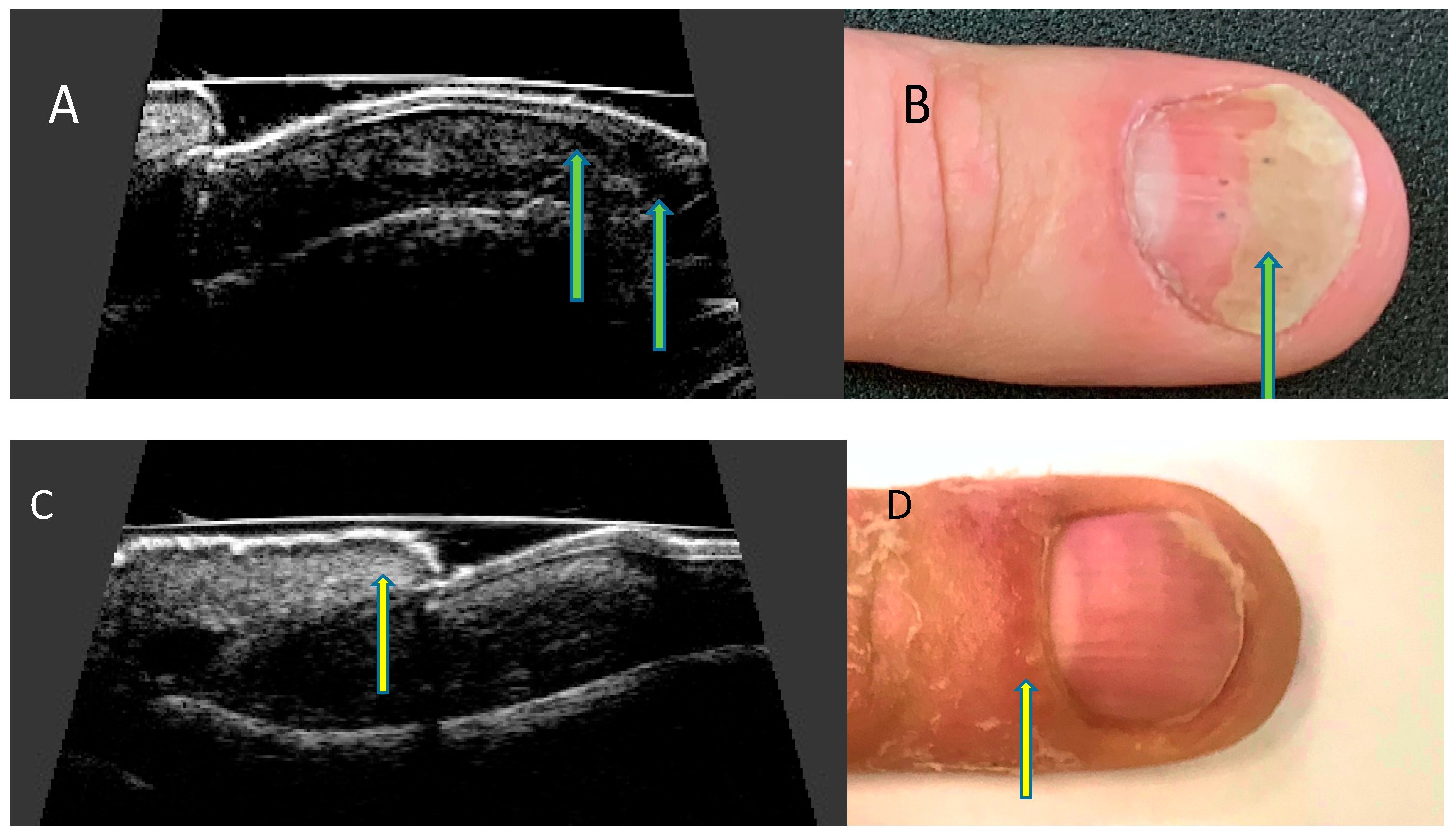 onycholysis psoriasis