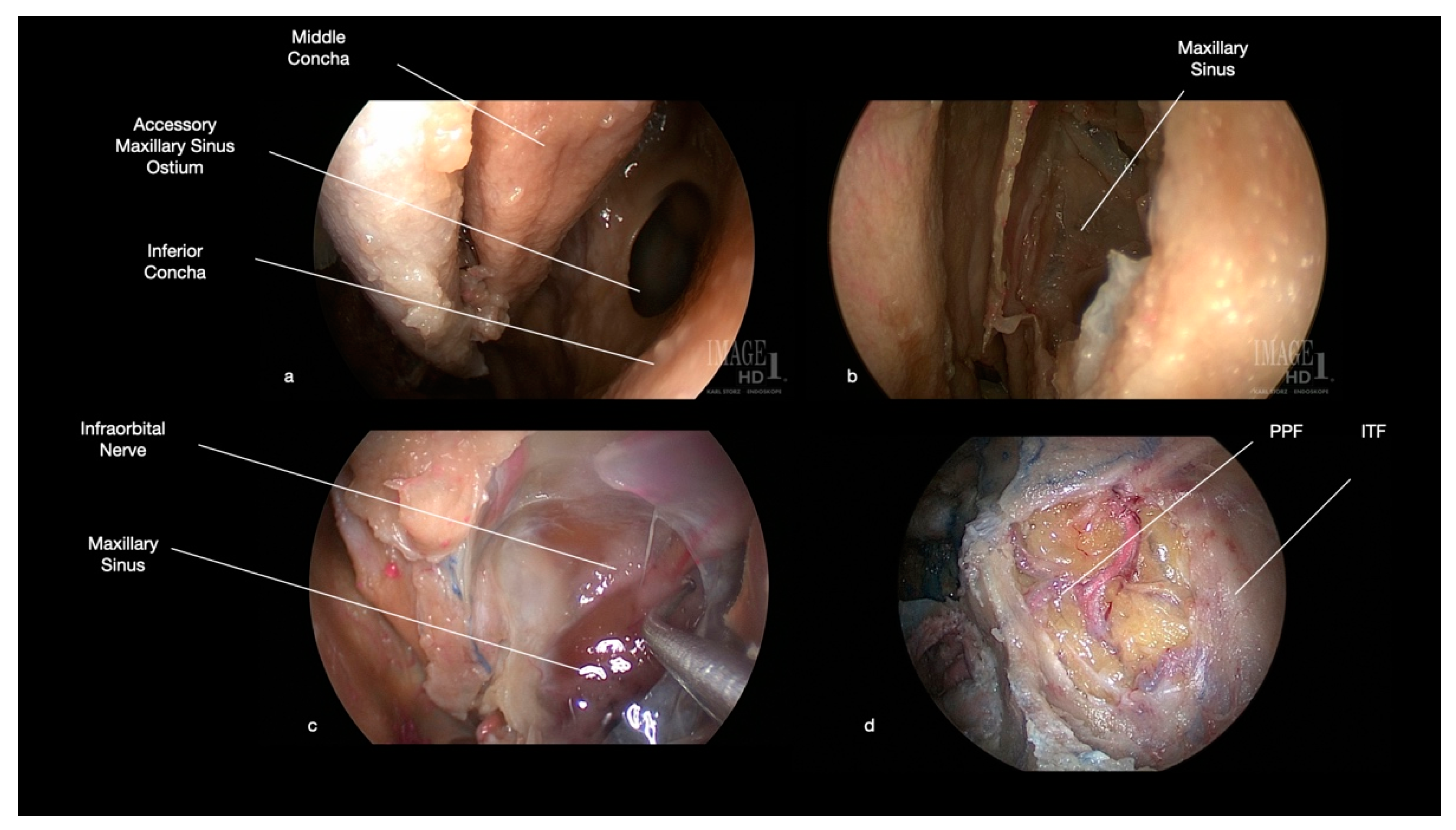 papilloma sinus c4