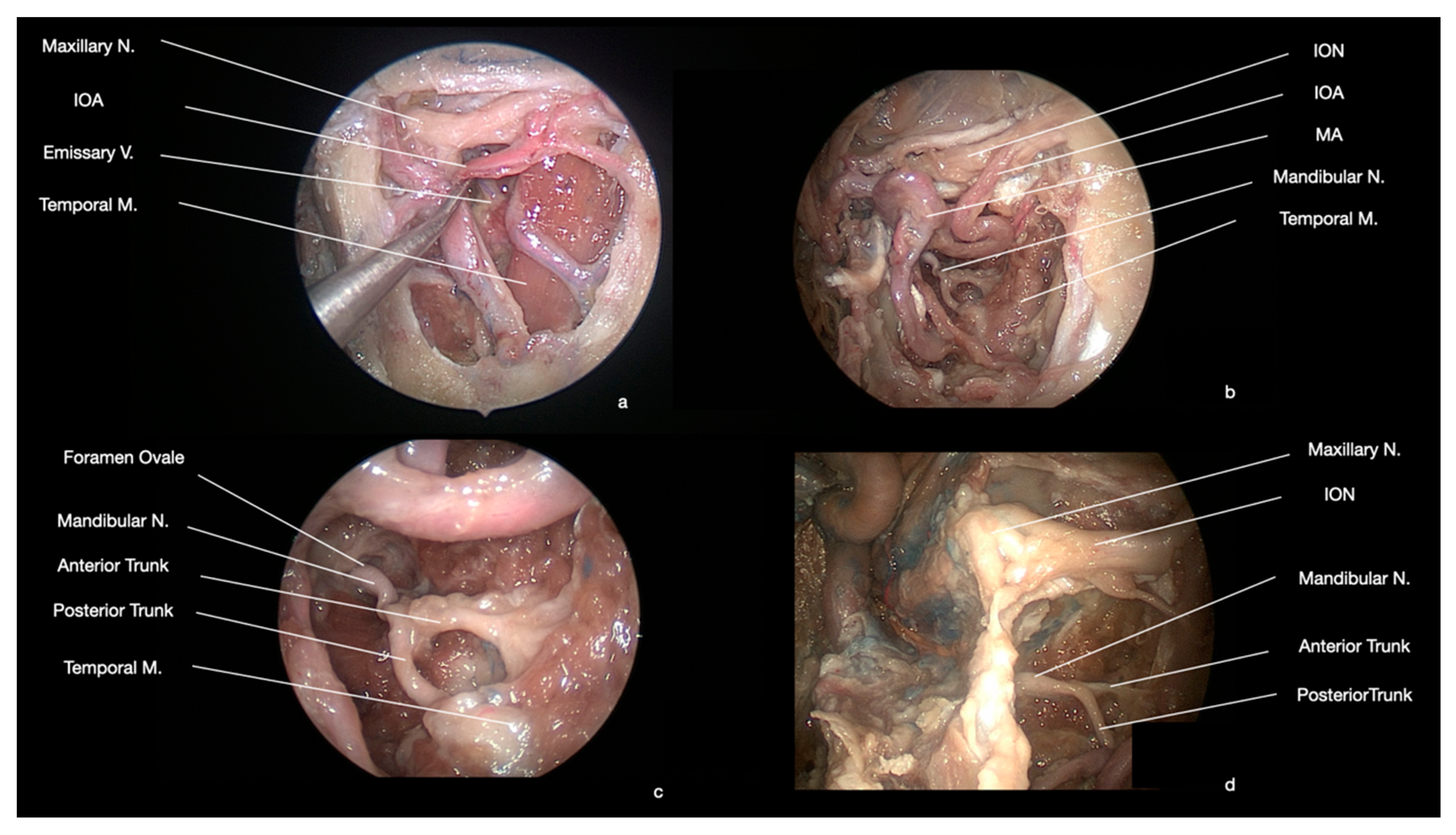 MN is a branch of the posterior trunk of the inferior alveolar nerve