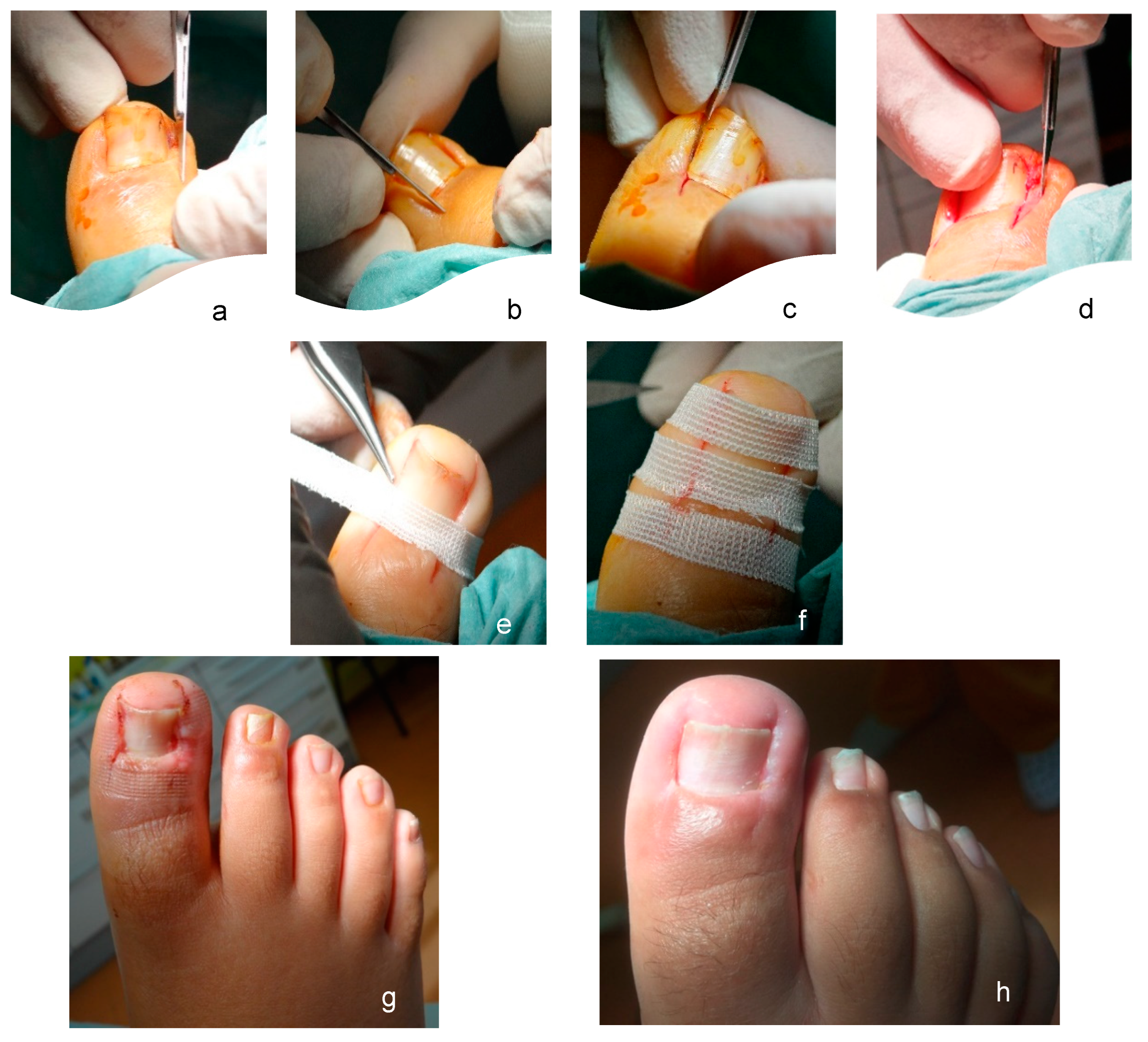 Surgery for ingrowing toenail (adult) | healthdirect