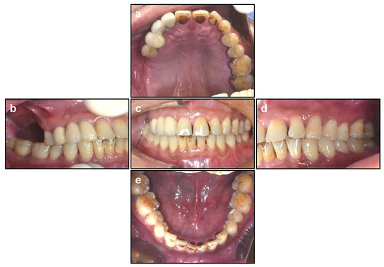 Modified Osteotome Sinus Floor Elevation Technique for Multiple ...