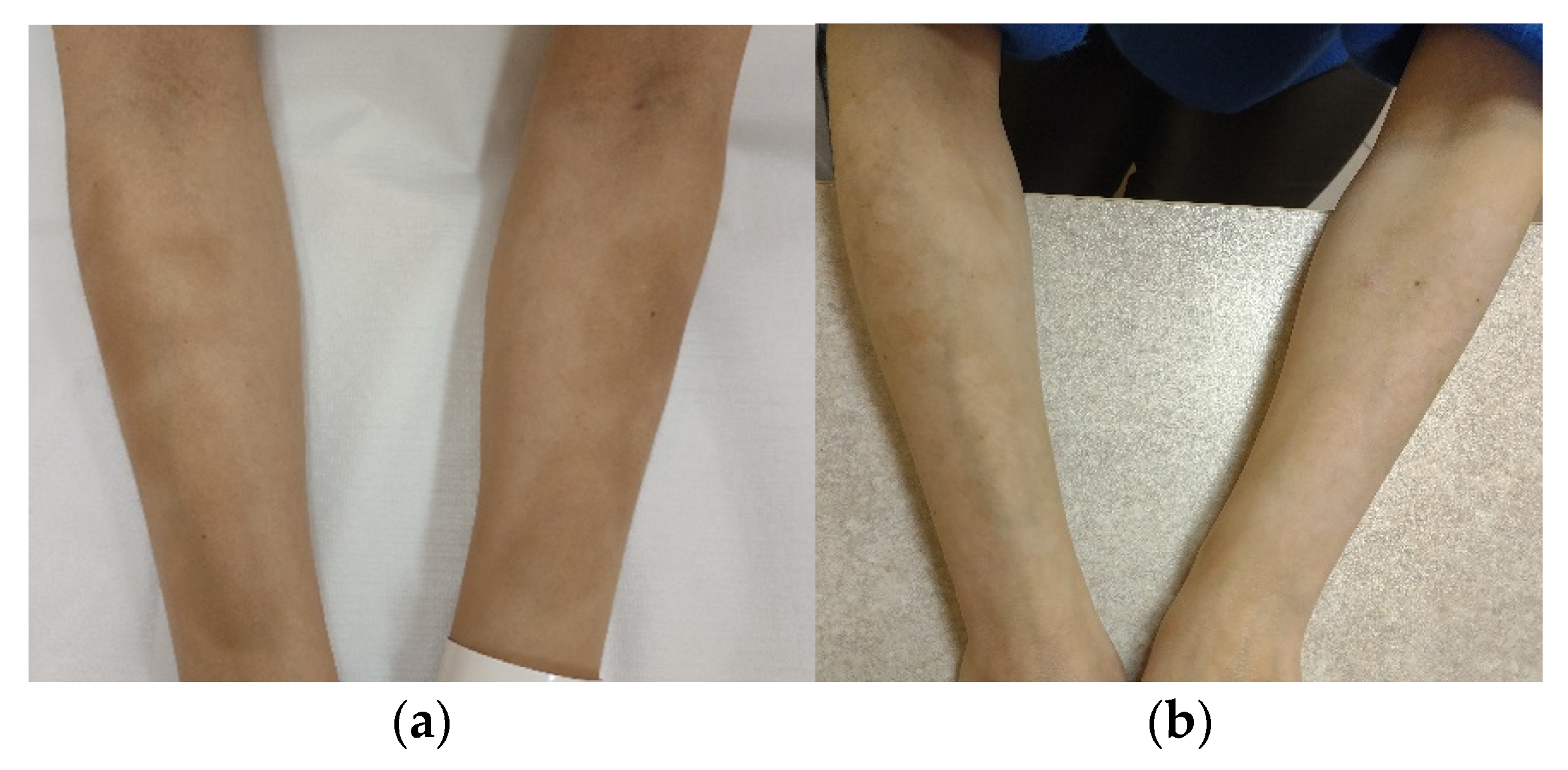IJERPH | Free Full-Text | Fractional Ablative Carbon Dioxide Lasers for the  Treatment of Morphea: A Case Series and Literature Review