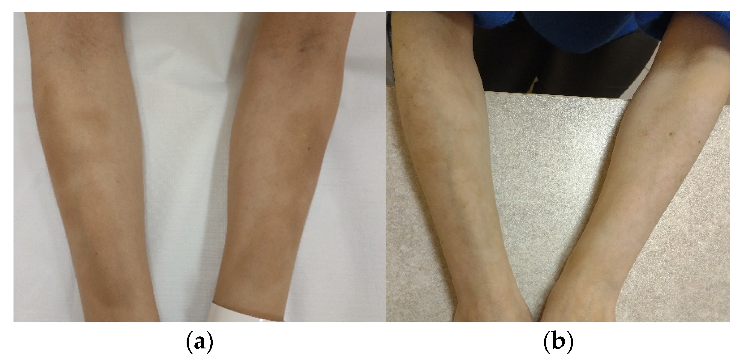 IJERPH | Free Full-Text | Fractional Ablative Carbon Dioxide Lasers for the Treatment of Morphea: A Case Series and Literature Review IJERPH | Free Full-Text | Fractional Ablative Carbon Dioxide Lasers for the Treatment of Morphea: A Case Series and Literature Review