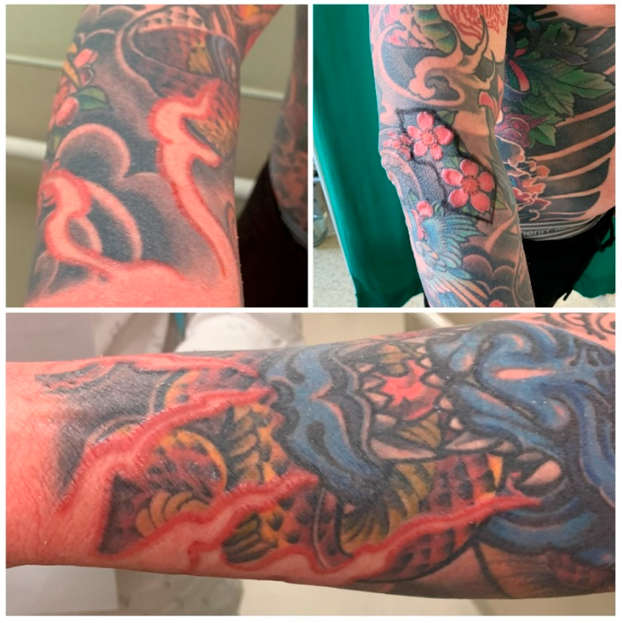IJERPH | Free Full-Text | When Body Art Goes Awry—Severe Systemic Allergic Reaction to Red Ink Tattoo Requiring Surgical Treatment IJERPH | Free Full-Text | When Body Art Goes Awry—Severe Systemic Allergic Reaction to Red Ink Tattoo Requiring Surgical Treatment