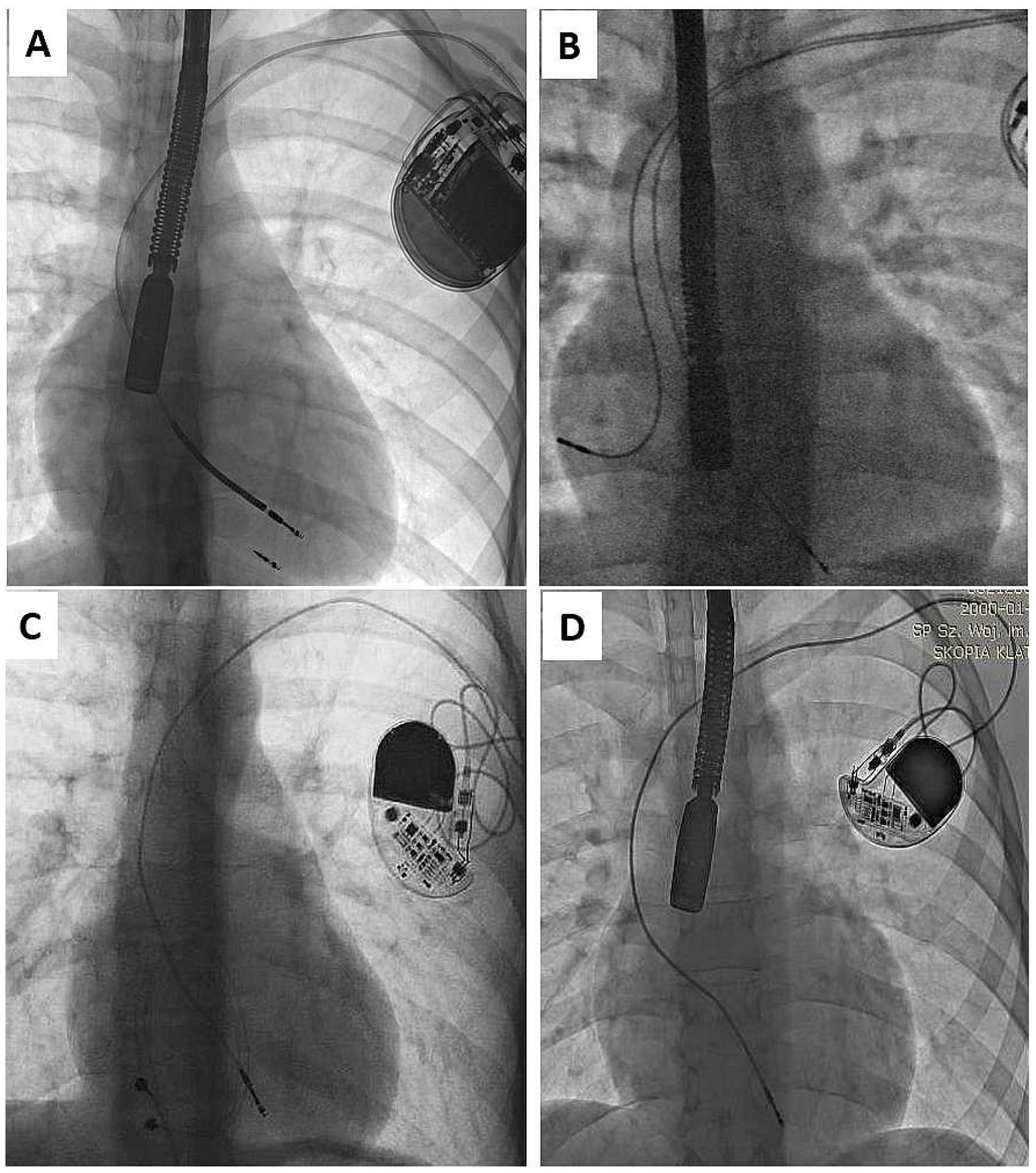 Transvenous Lead Extraction in Adult Patient with Leads
