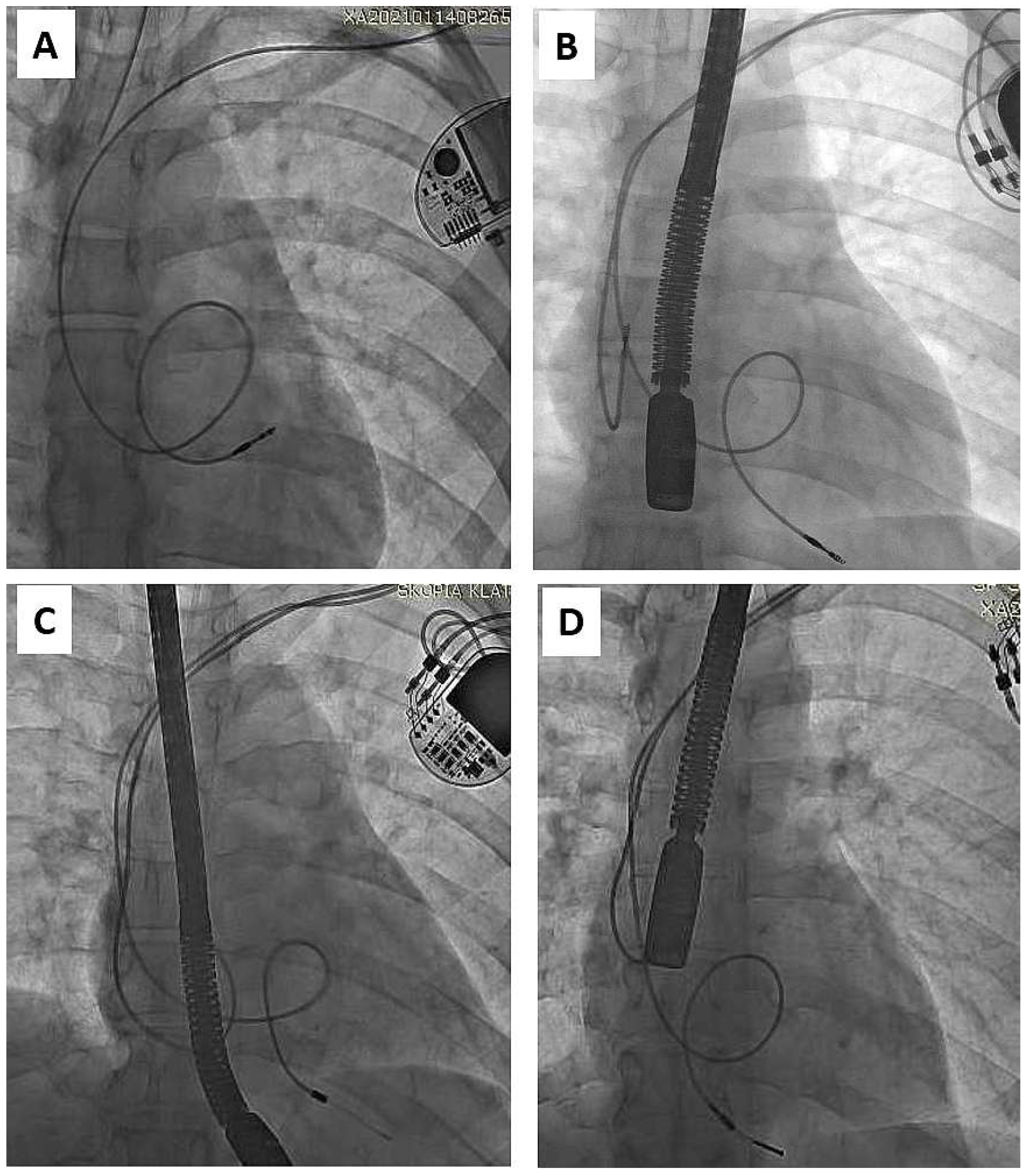 Efficacy and safety of transvenous lead extraction using a