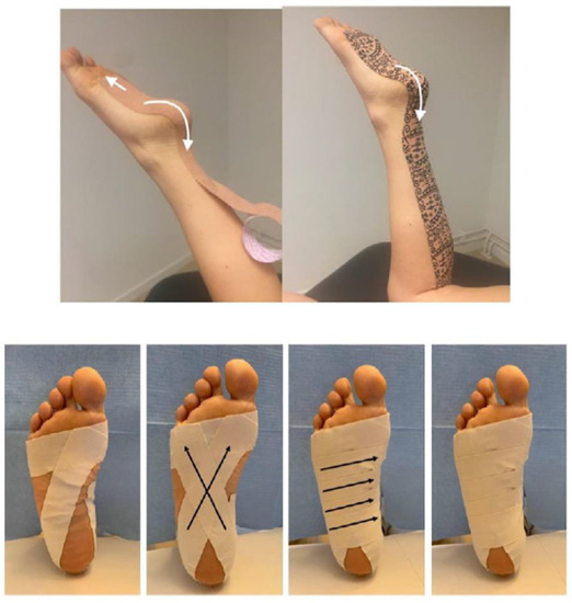 Plantar fascia strain taping hotsell
