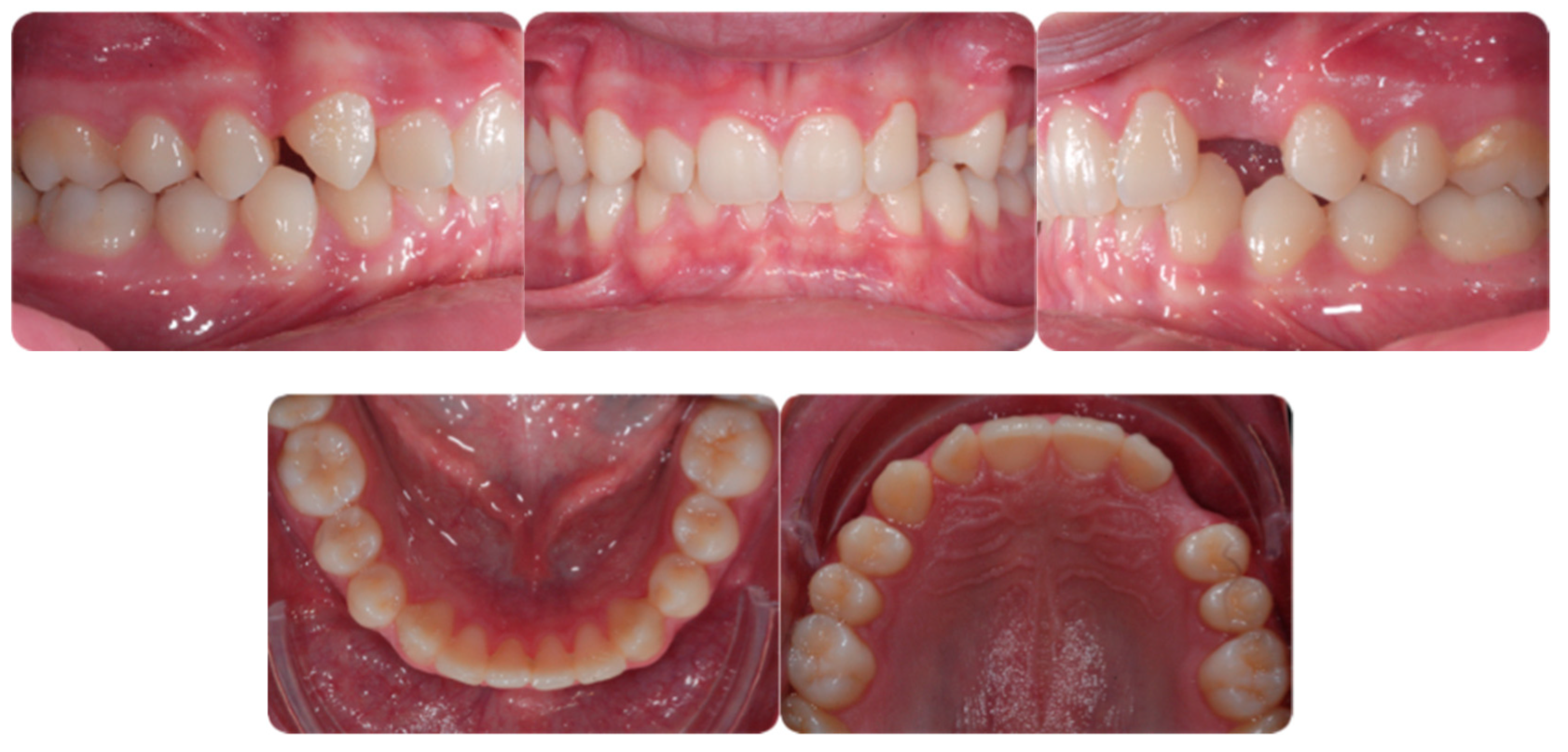 EFFECT OF GINGIVECTOMY ON MEAN EXPOSED LINGUAL OR PALATAL ROOT SURFACE