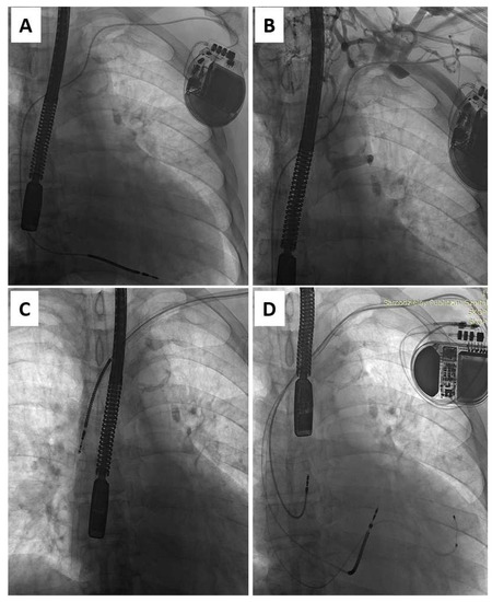 Transvenous Lead Extraction: From Simple Traction to Internal Transjugular Approach [ペーパーバック] Bongiorni， Maria Grazia Efficacy and Safety of Transvenous Lead Extraction at the