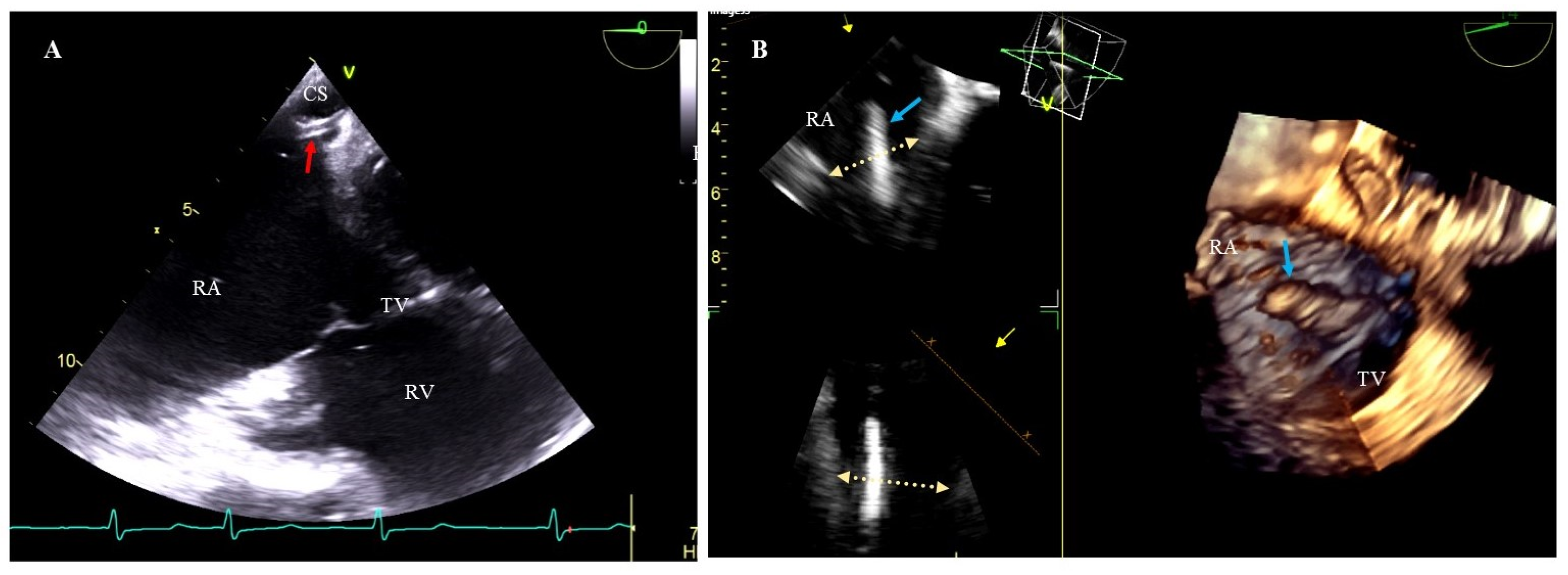 Transvenous Lead Extraction: From Simple Traction to