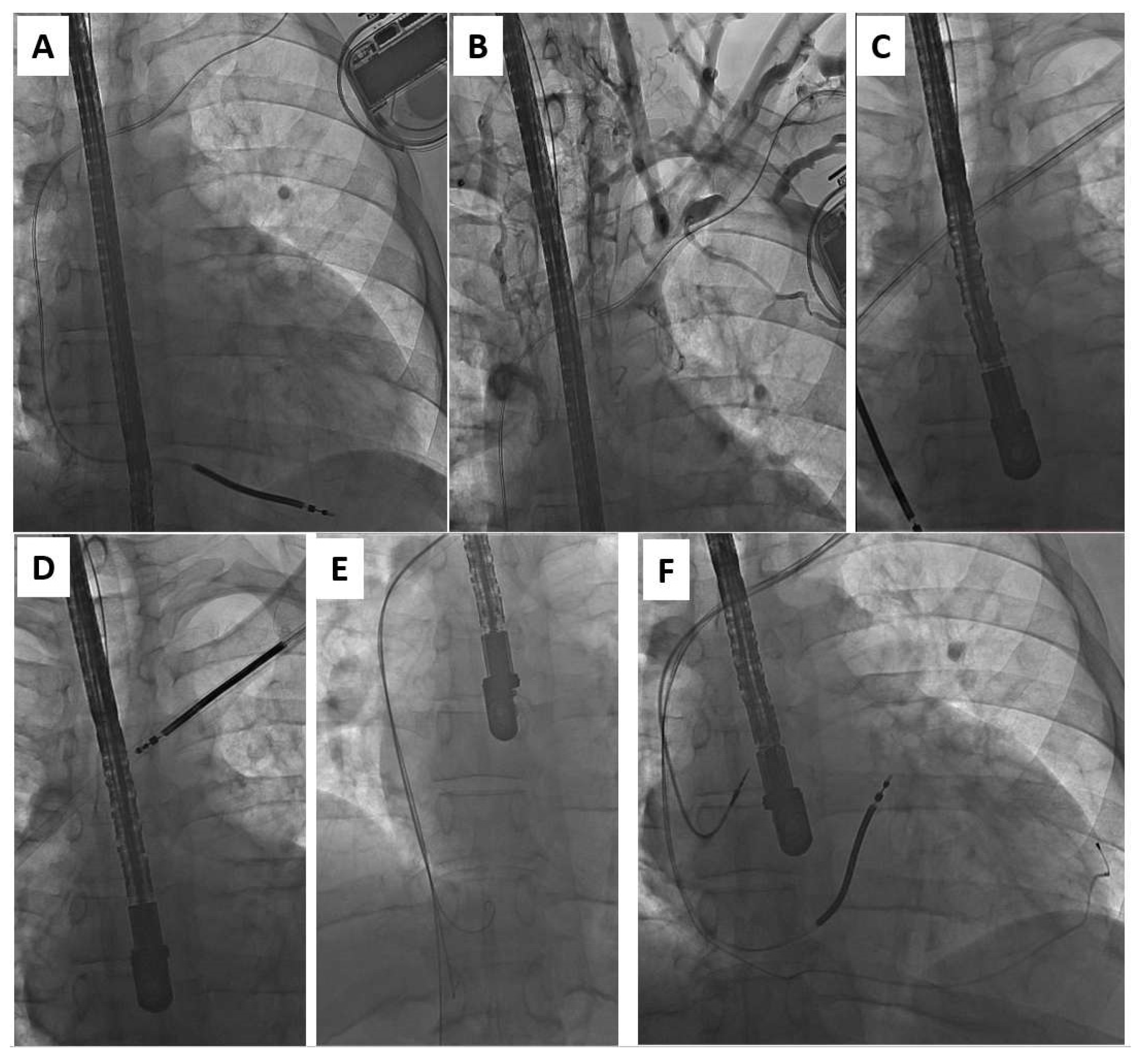 【オープニングセール】 Transvenous of Safety and Efficacy Lead the at Extraction 語学+参考書