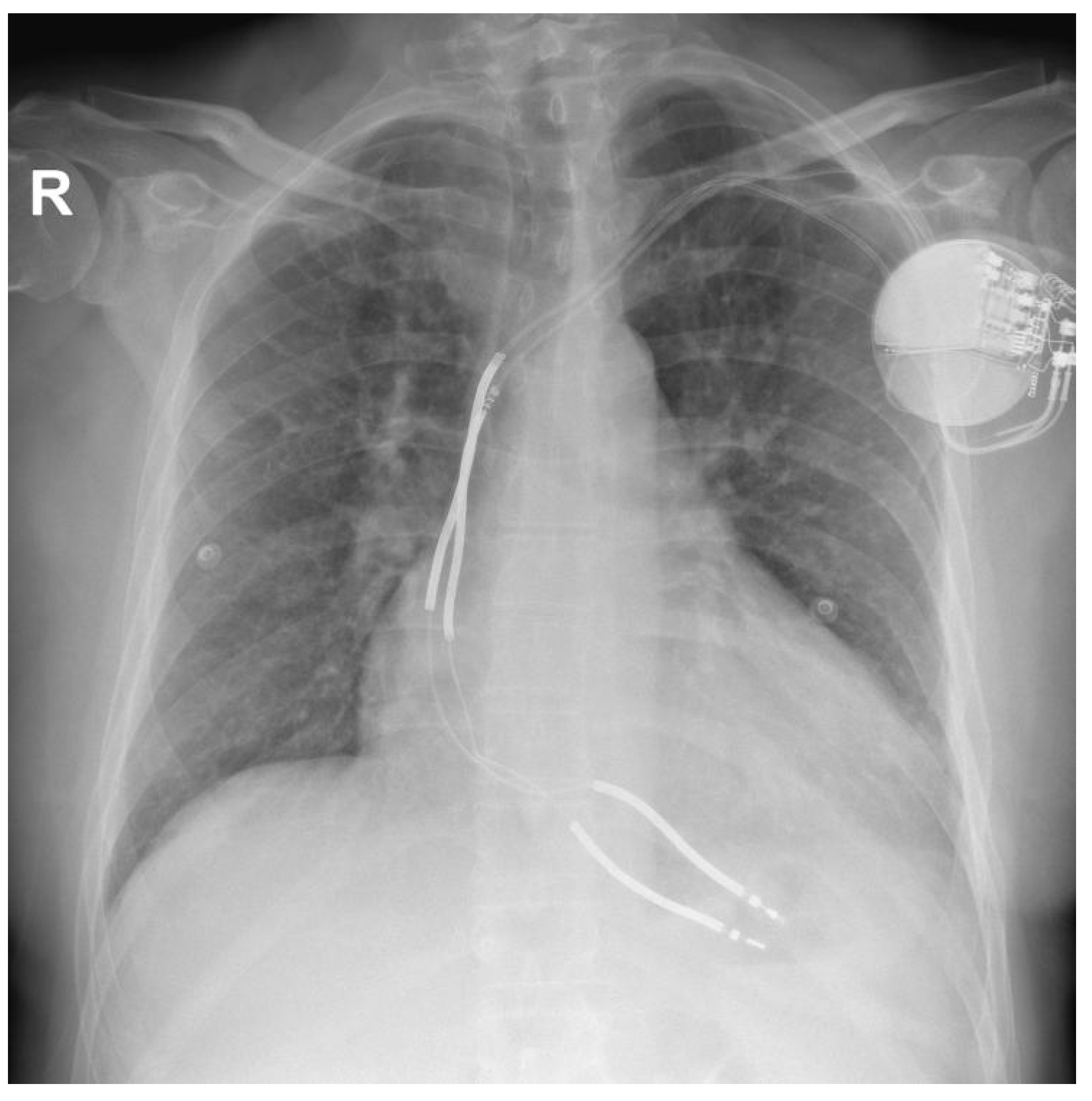 Practical Approaches to Transvenous Lead Extraction