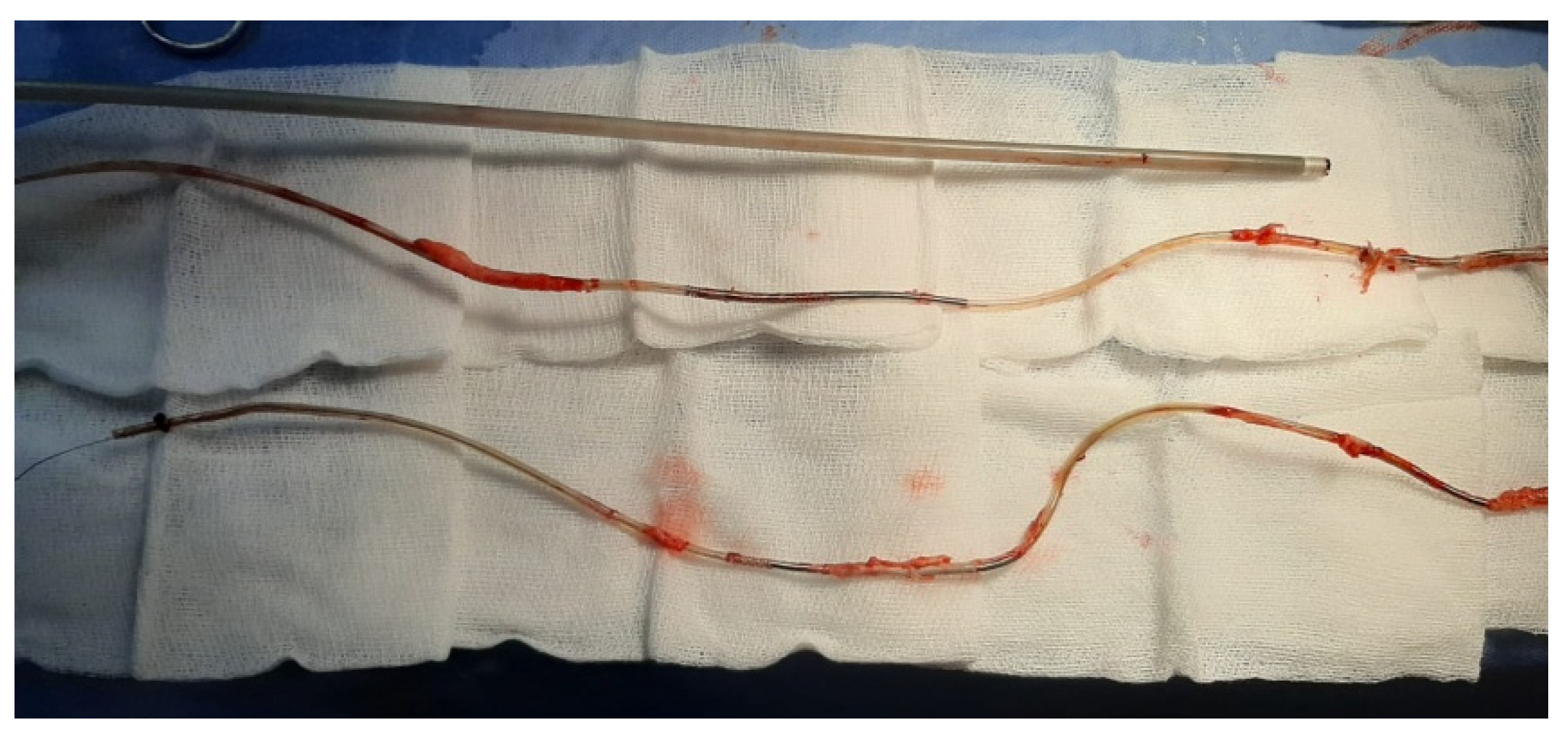 Transvenous Lead Extraction: From Simple Traction to Internal Transjugular Approach [ペーパーバック] Bongiorni， Maria Grazia Transvenous lead extraction: The subclavian-to-jugular pull