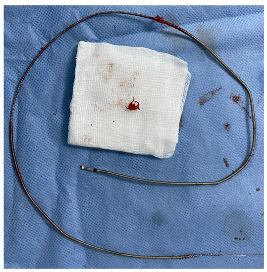 Practical Approaches to Transvenous Lead Extraction