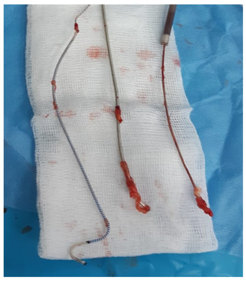 Practical Approaches to Transvenous Lead Extraction