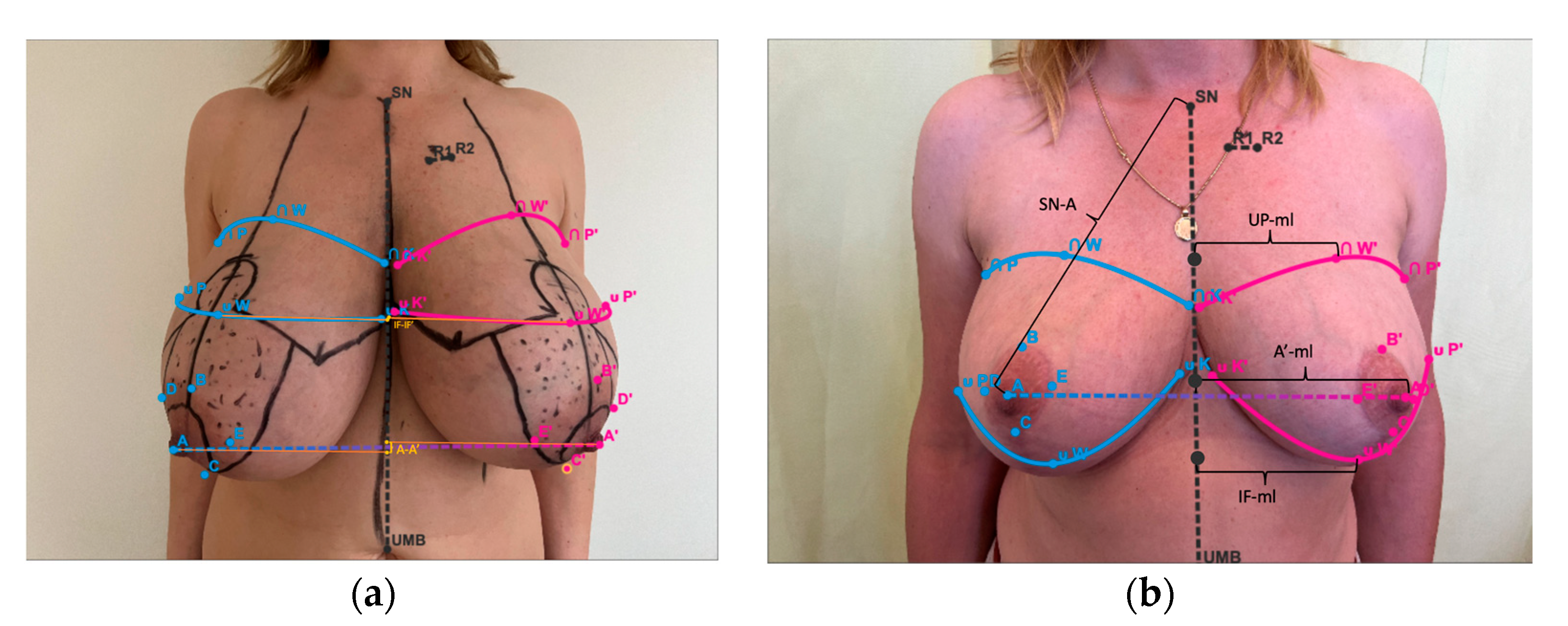 a Patient's positioning on a breast board, without breast bra