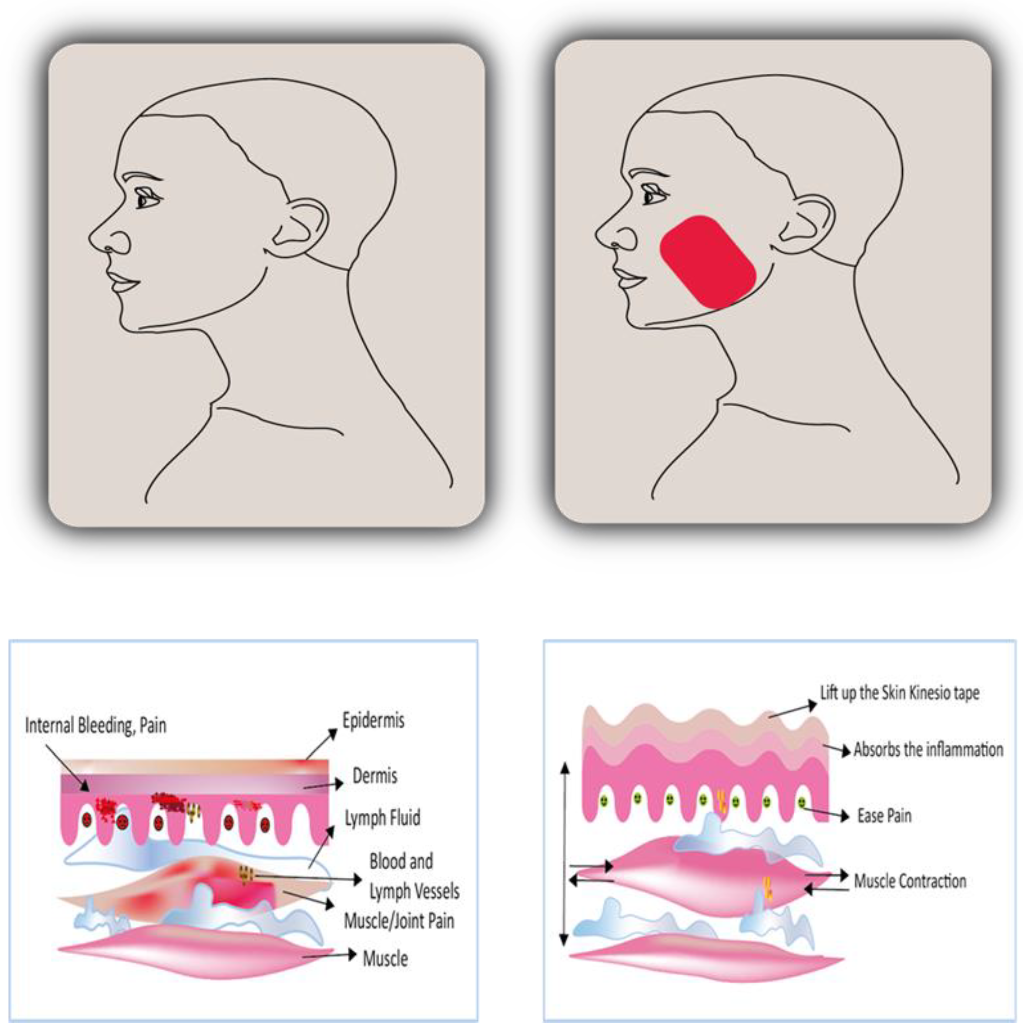 Kinesio Taping as a Therapeutic Tool for Masticatory
