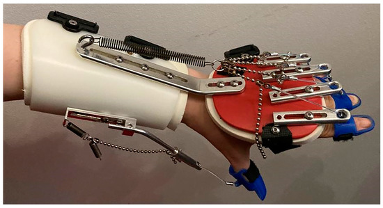 Botulinum Toxin and Dynamic Splint Restore Grasping Function after ...