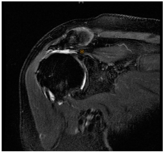 Massive rotator cuff tear discount