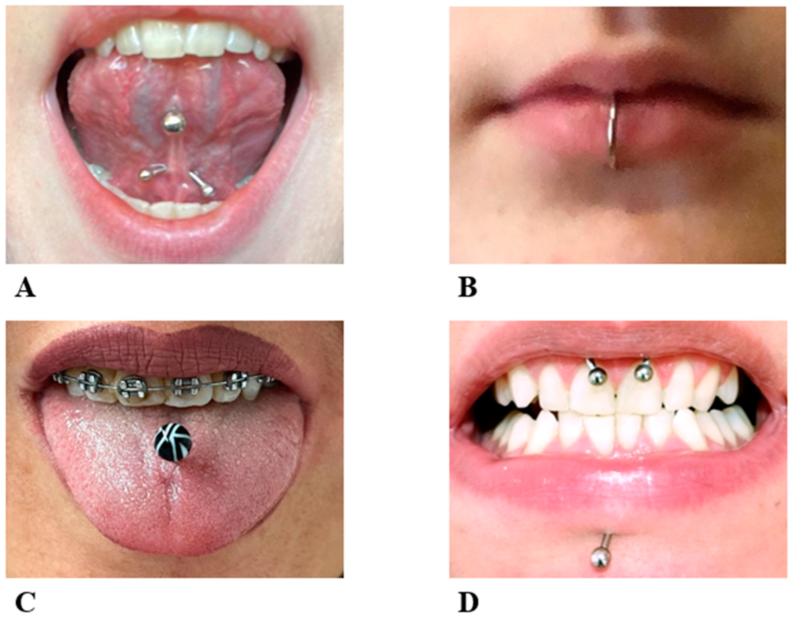 Oral piercing: what are the risks?