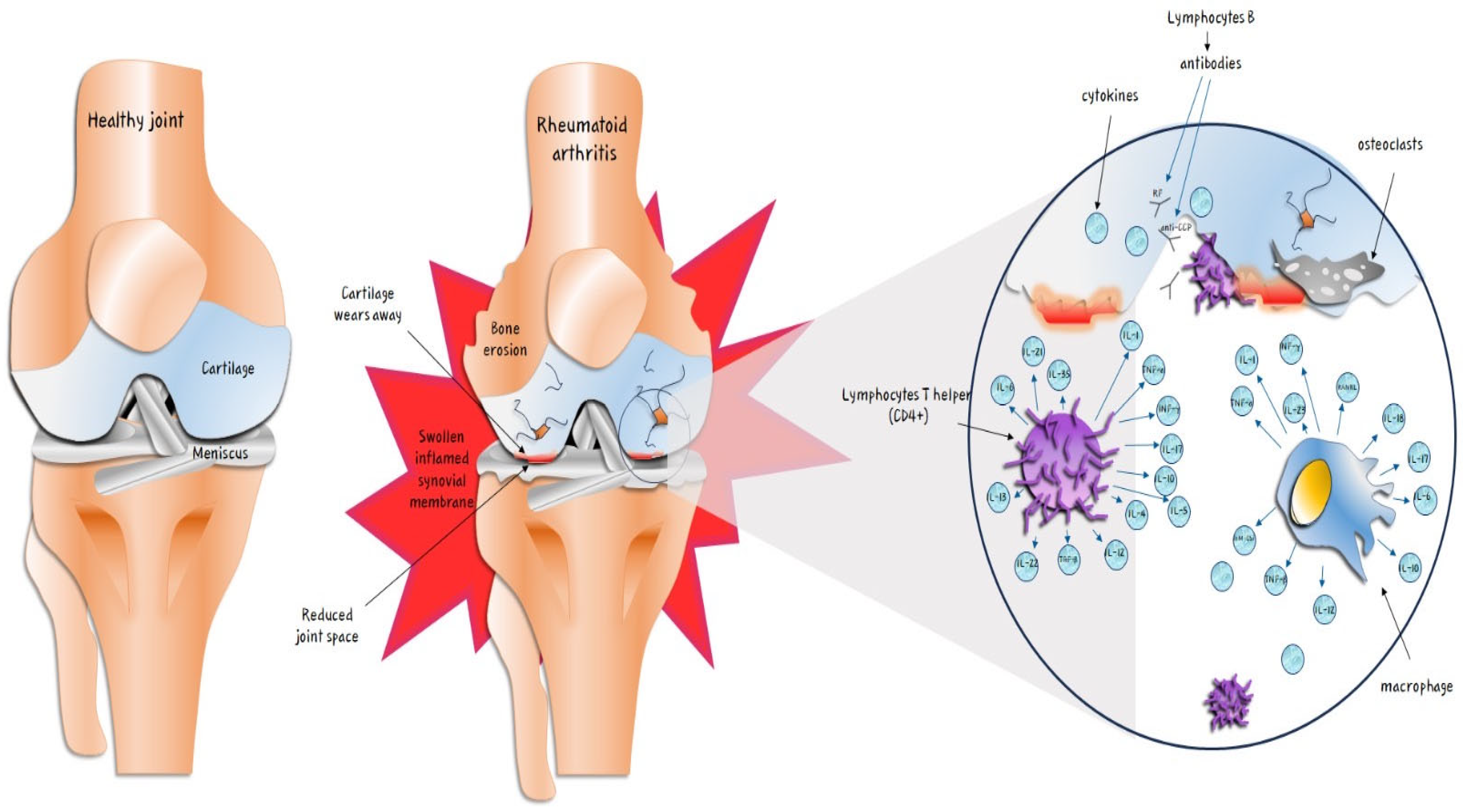語学+参考書 Infections and the Rheumatic Diseases Arthritis and Autoimmune Disease: The Infection Connection
