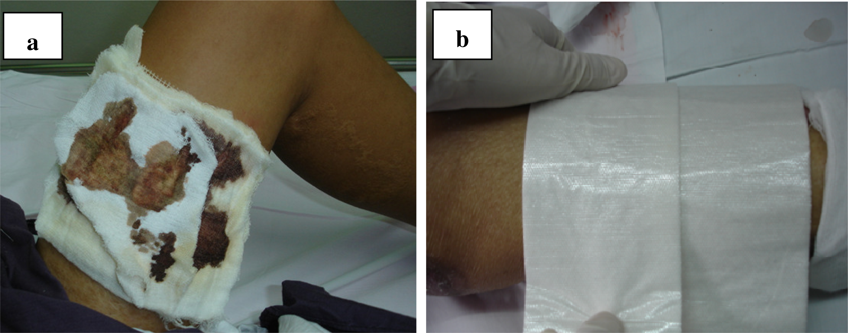 Biomedical materials for wound dressing: recent advances and applications -  RSC Advances (RSC Publishing) DOI:10.1039/D2RA07673J