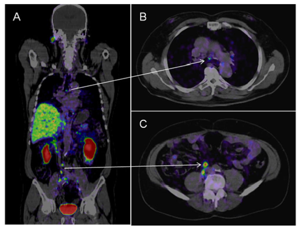 Позитрон-эмиссионная  томография: ПЭТ. ПЭТ/кт Discovery Pet/CT 610. Рэт кт метастазы.