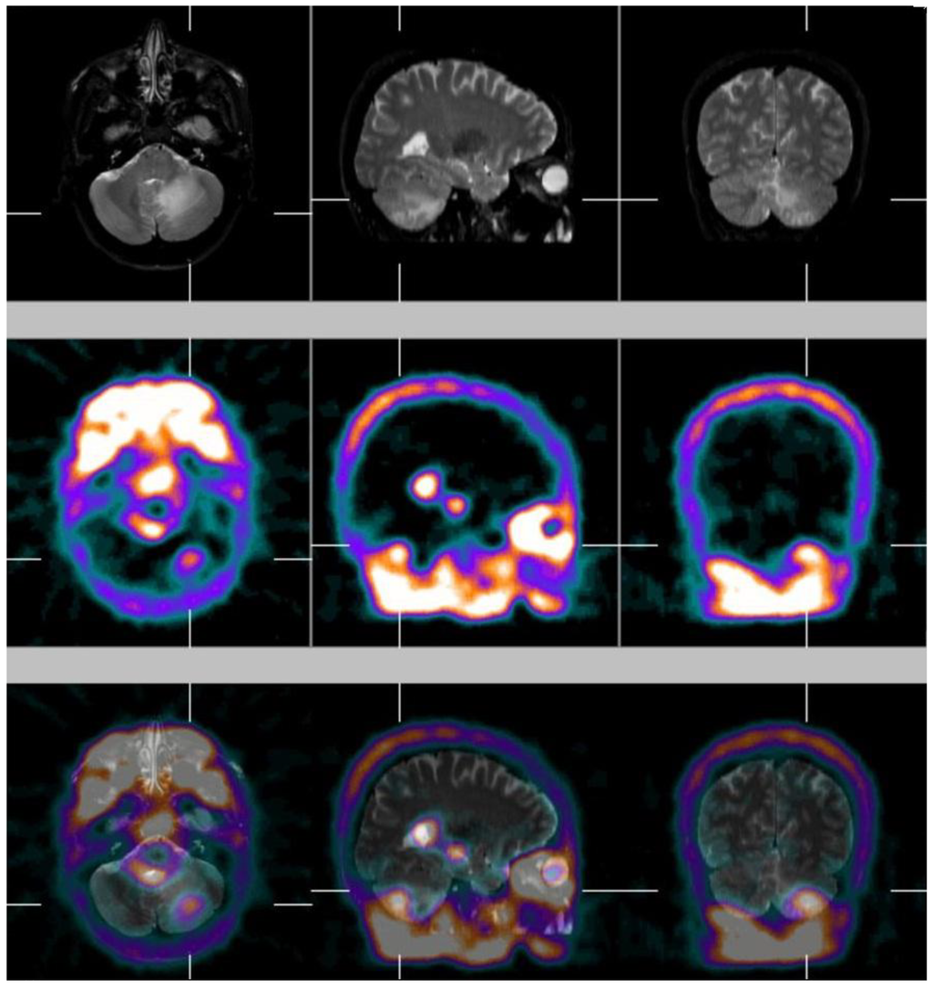 Ijms Special Issue Brain Metastasis 2014 Ijms Special Issue Brain Metastasis 2014