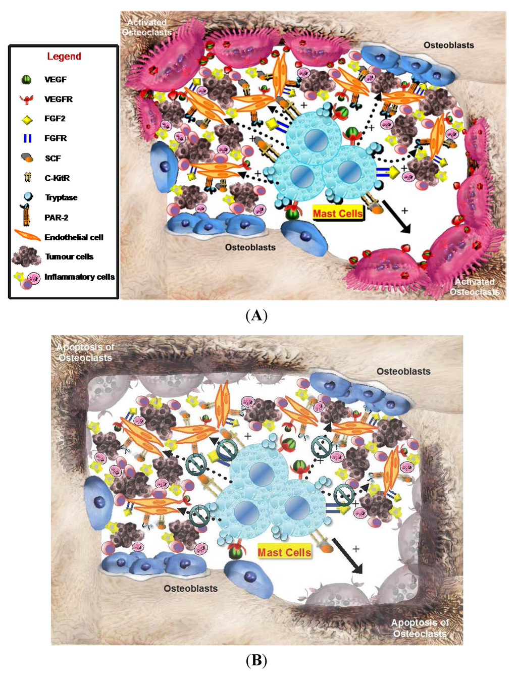 Infiltrating Mast Cells Correlate with Angiogenesis in Bone Metastases ...