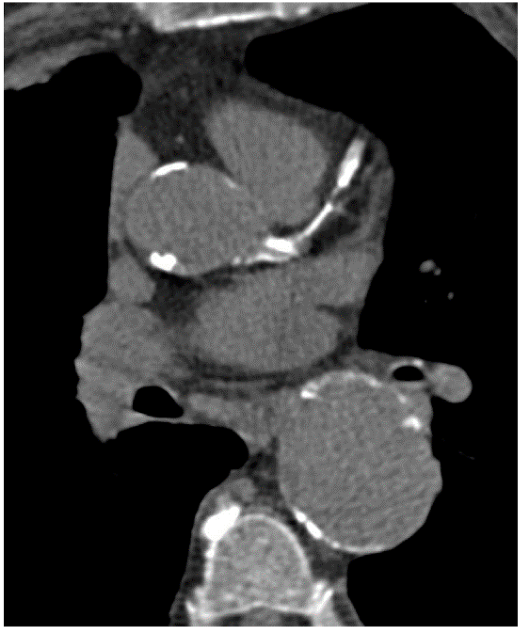IJMS Free FullText Coronary CT Angiography in Managing Atherosclerosis