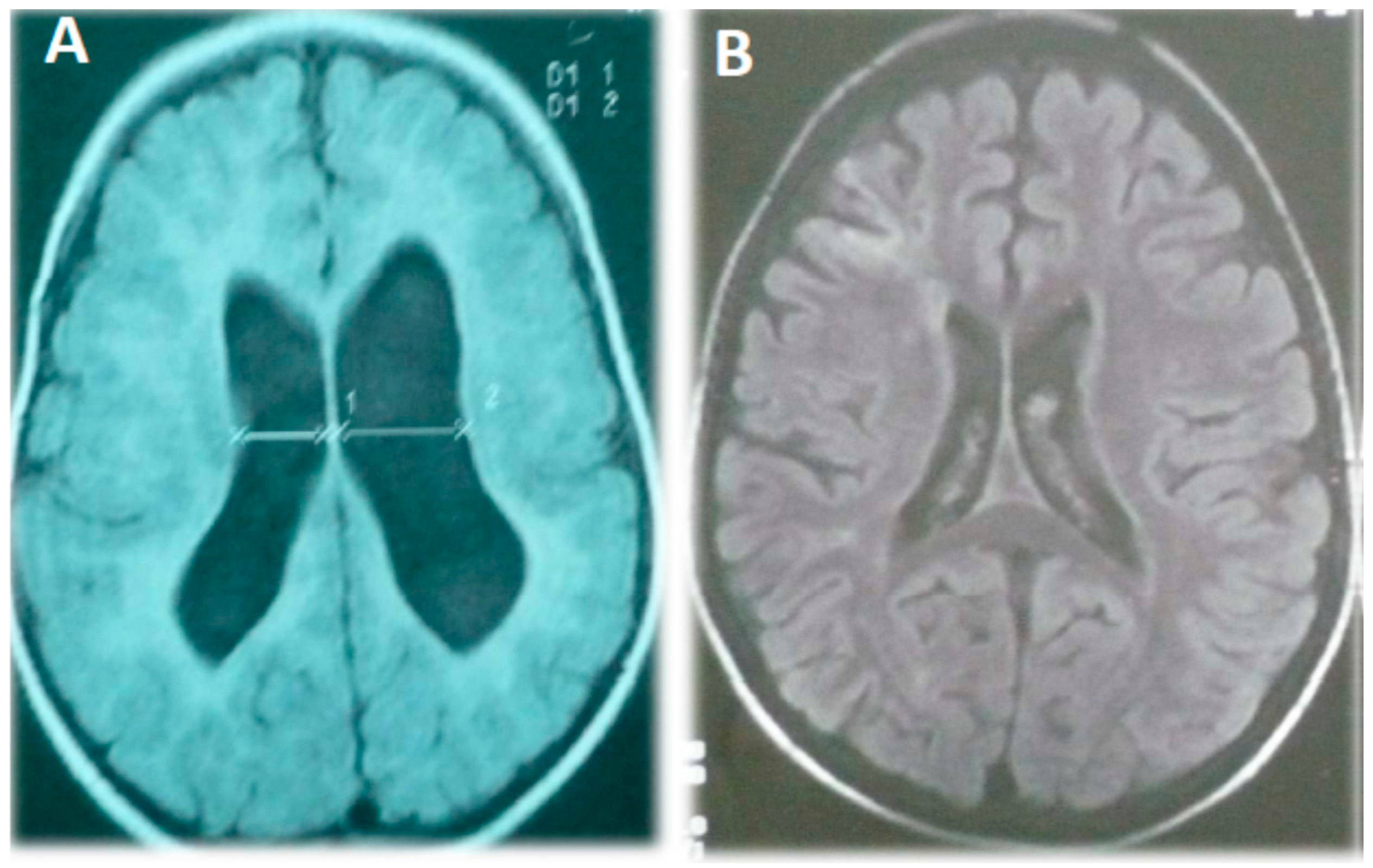 Autism With Intellectual Disability >> Ijms Free Full Text Autism And Intellectual Disability Autism With Intellectual Disability >> Ijms Free Full Text Autism And Intellectual Disability