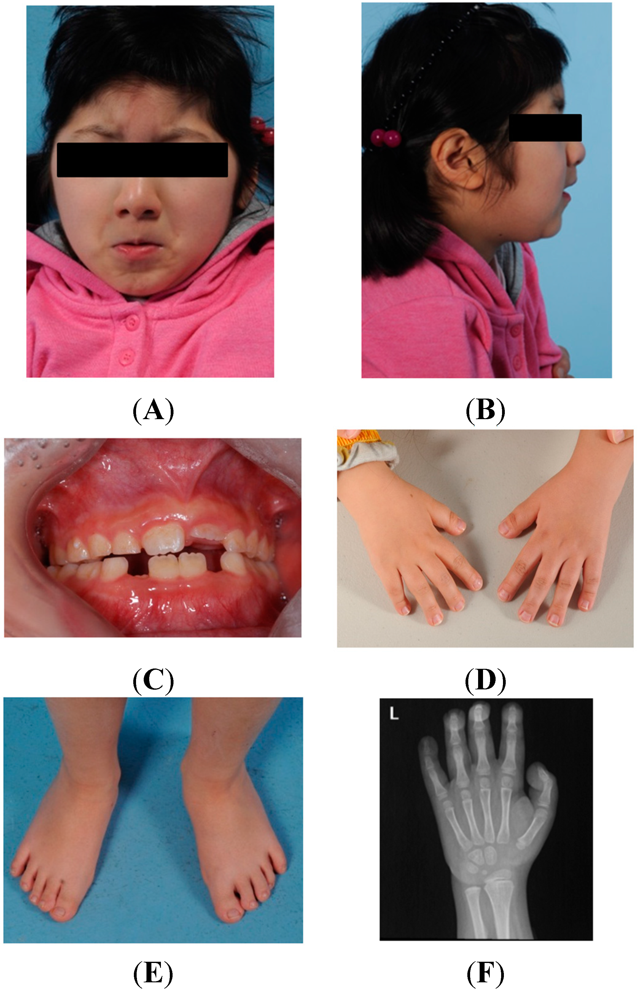 Facial features of Rubinstein-Taybi syndrome