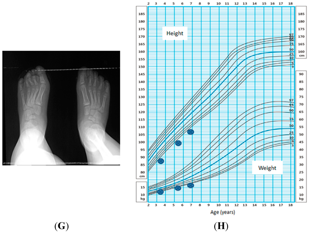 Molecular studies in 10 cases of Rubinstein-Taybi syndrome, including a  mild variant showing a missense mutation in codon 1175 of CREBBP