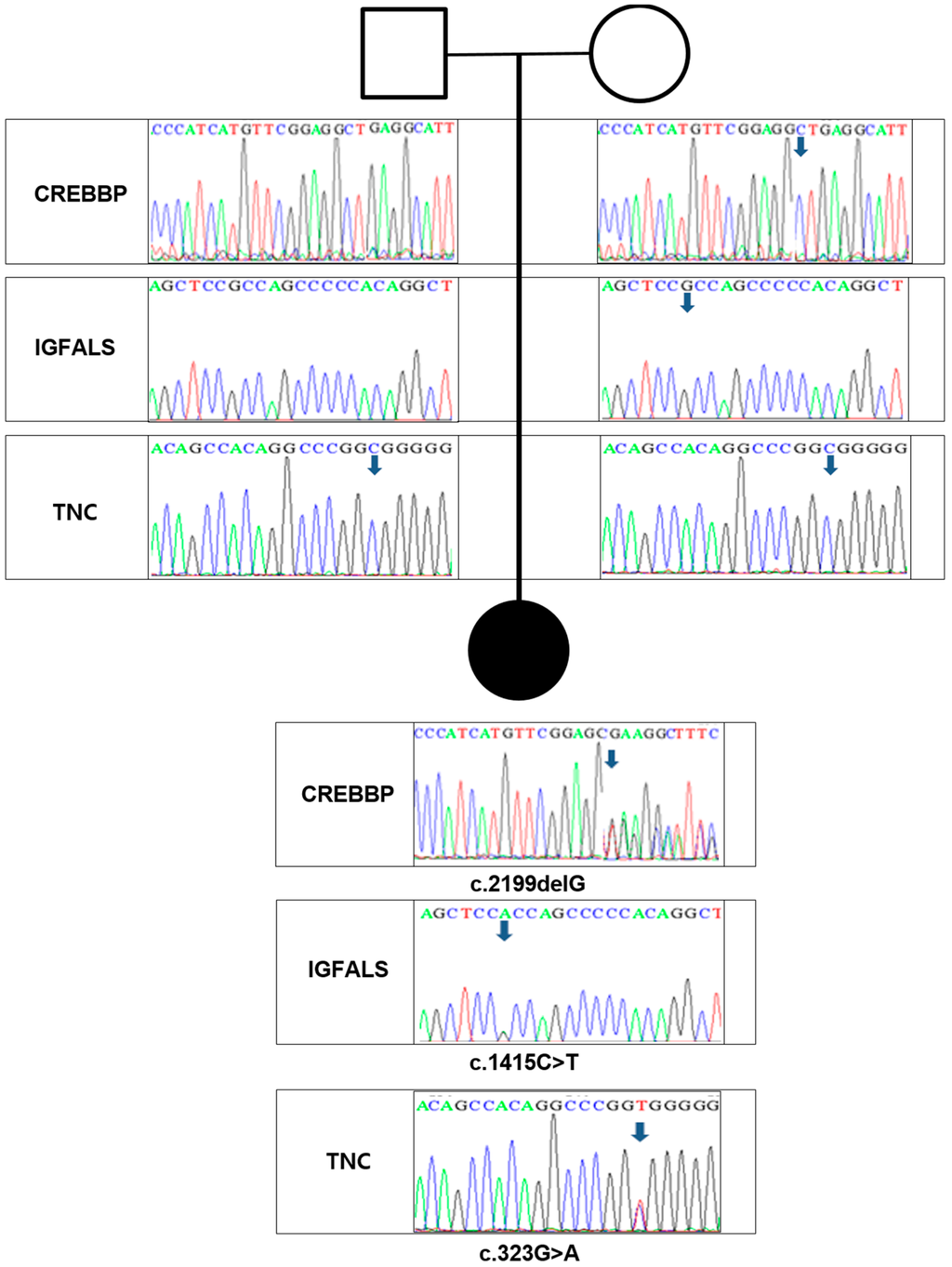 A case with Rubinstein-Taybi syndrome: A novel frameshift mutation