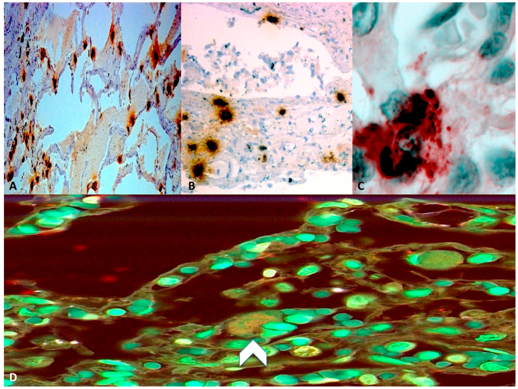amniotic fluid embolism pdf amniotic fluid embolism pdf