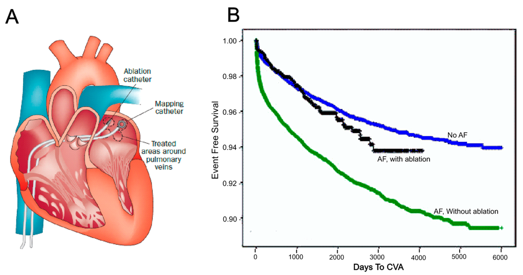 Ijms Free Full Text Optimization Of Catheter Ablation Of Atrial
