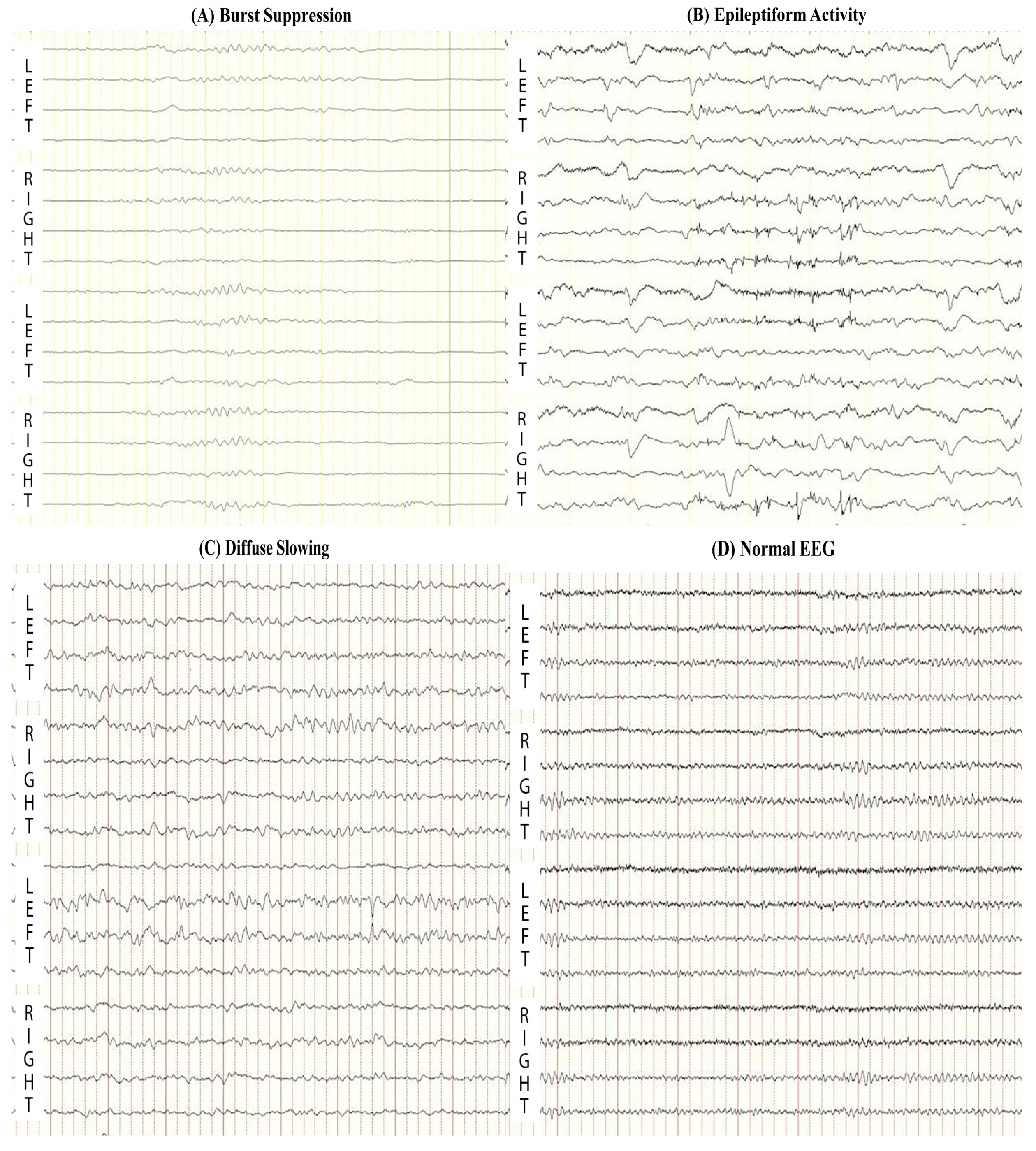 Normal Versus Abnormal Eeg