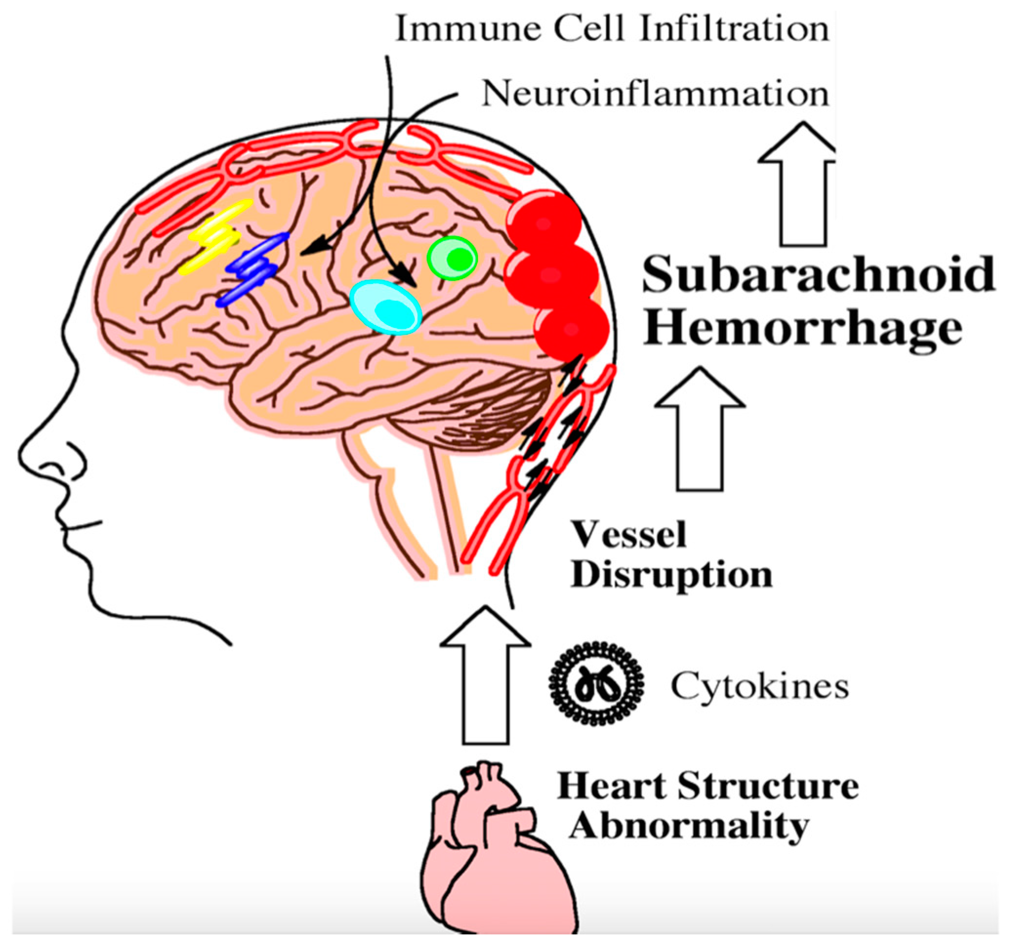 Subarachnoid Hemorrhage (SAH) - Brain, Spinal Cord, and Nerve