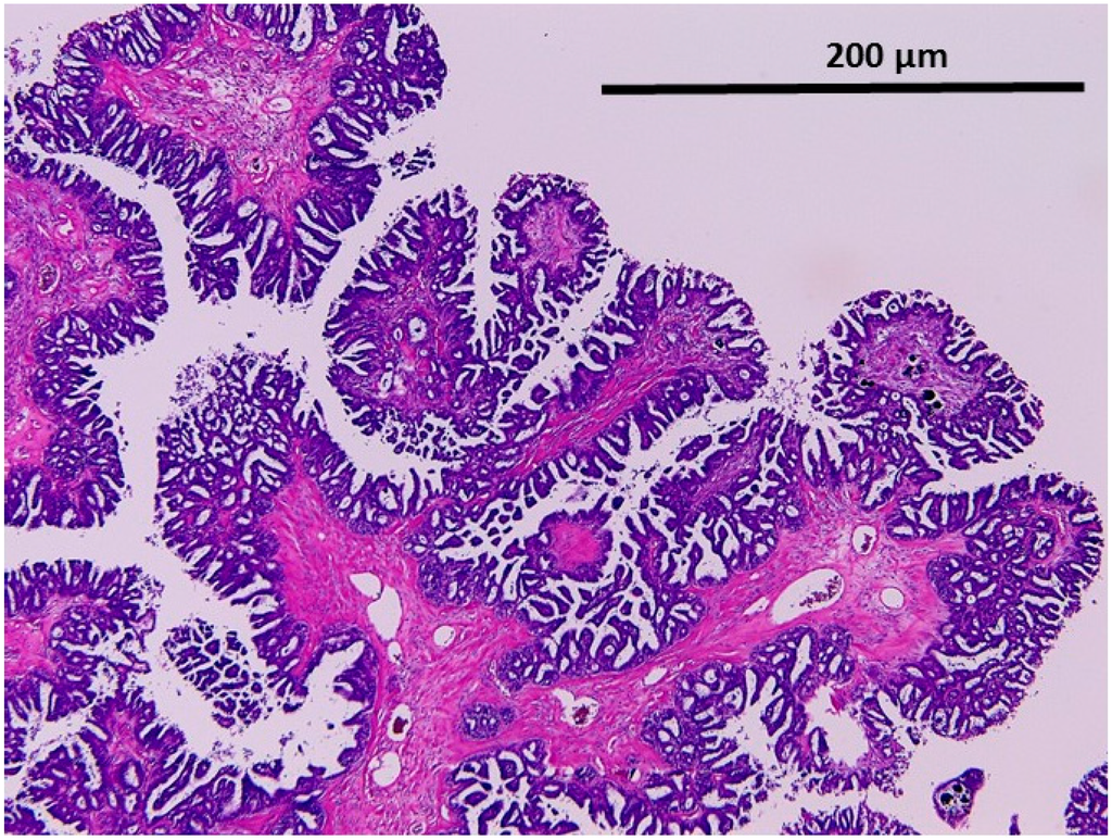 KRAS/BRAF Analysis in Ovarian Low-Grade Serous Carcinoma Having