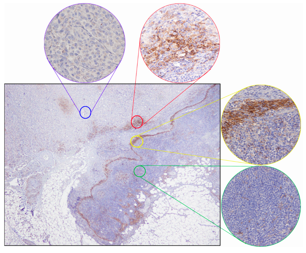 PD-L1 Immunohistochemical Detection in Tumor Cells and Tumor ...