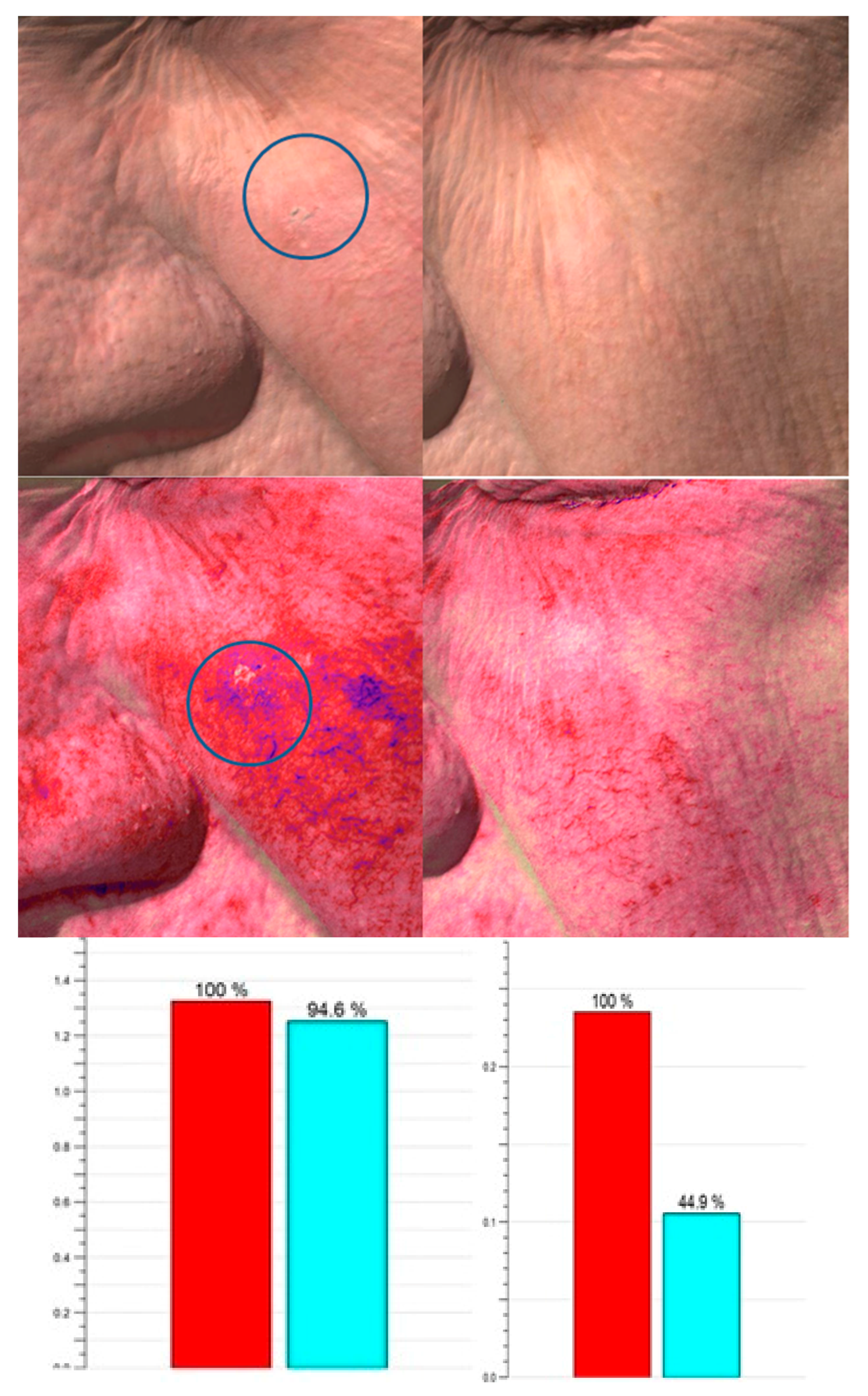 extract zondag Voorafgaan IJMS | Free Full-Text | MAL Daylight Photodynamic Therapy for Actinic Keratosis: Clinical and Imaging Evaluation by 3D Camera extract zondag Voorafgaan IJMS | Free Full-Text | MAL Daylight Photodynamic Therapy for Actinic Keratosis: Clinical and Imaging Evaluation by 3D Camera
