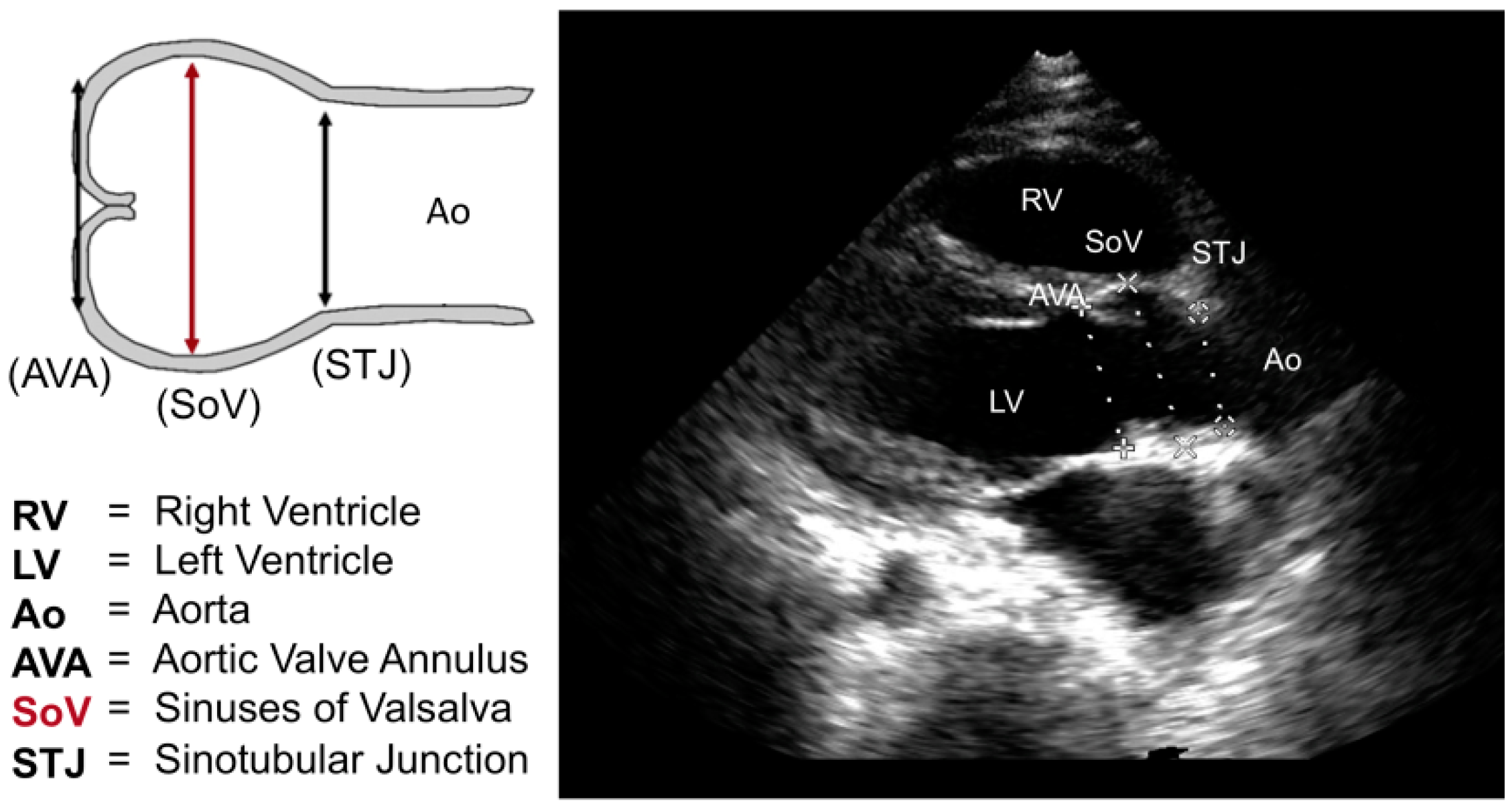 normal aortic arch diameter