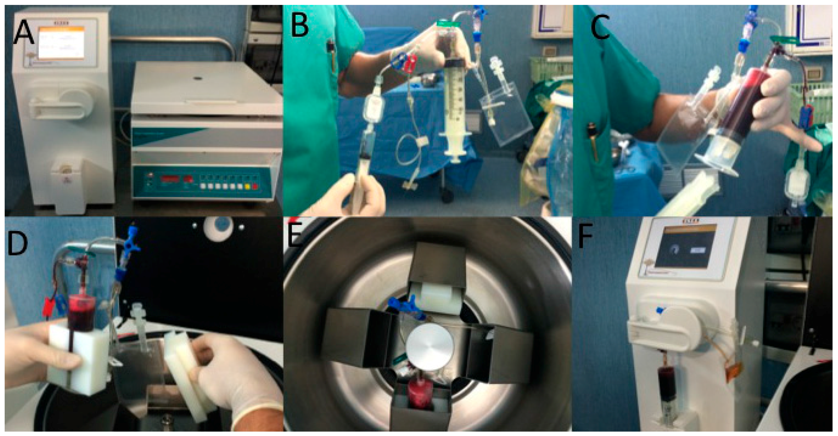 Ijms Free Full Text Evaluation Of Not Activated And Activated Prp In Hair Loss Treatment Role Of Growth Factor And Cytokine Concentrations Obtained By Different Collection Systems Html