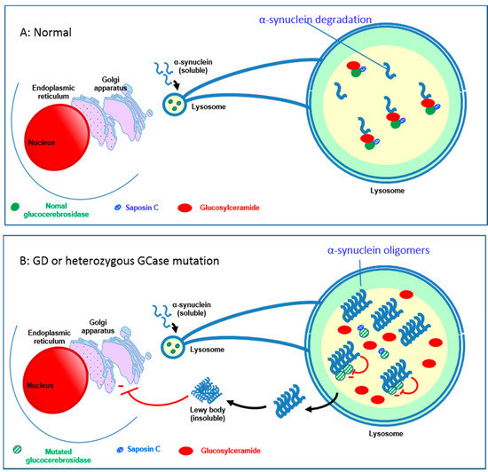 Niemann-Pick disease types A and B (NORD): Video