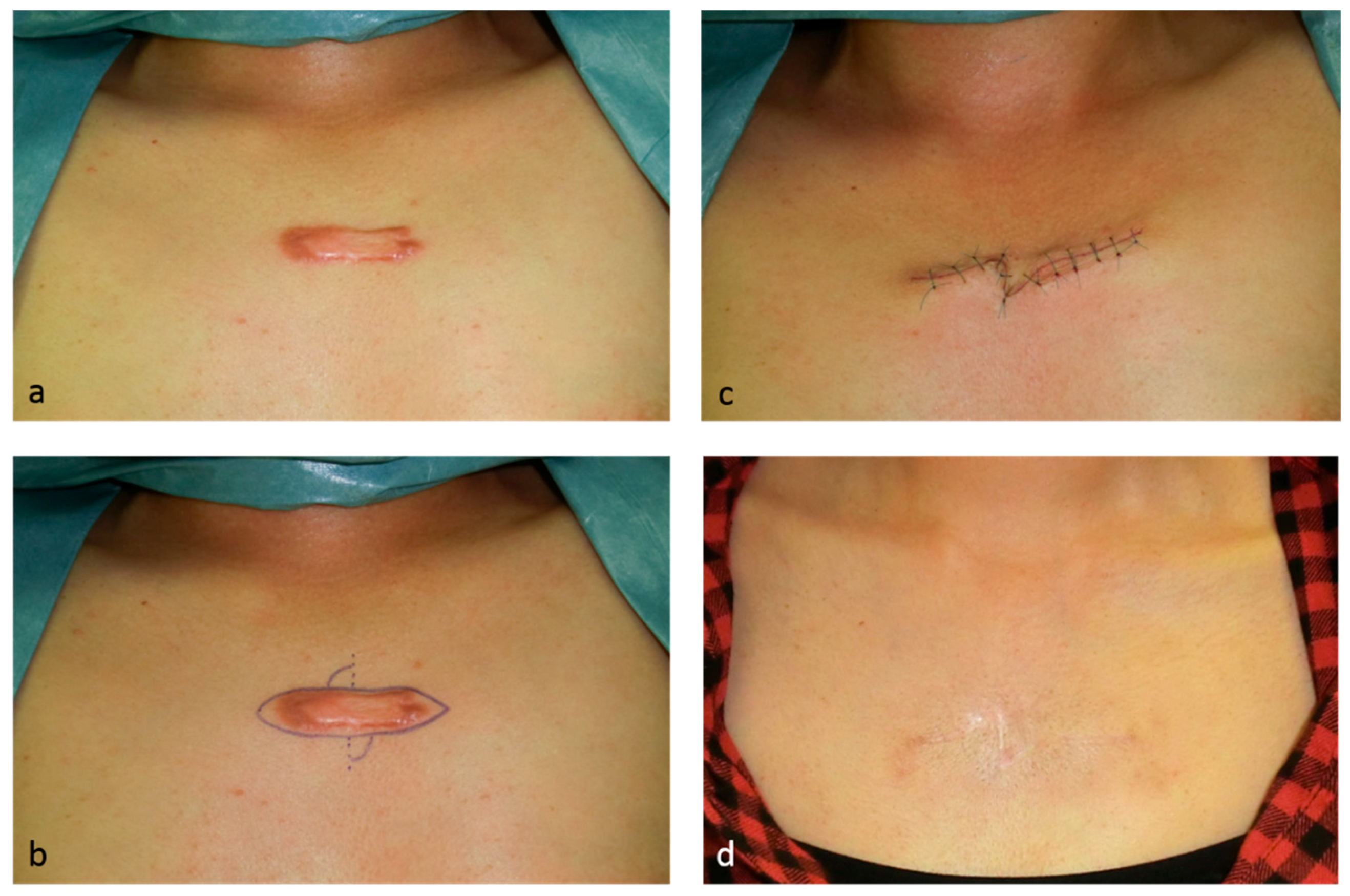 IJMS | Free Full-Text | Keloid and Hypertrophic Scars Are the Result of