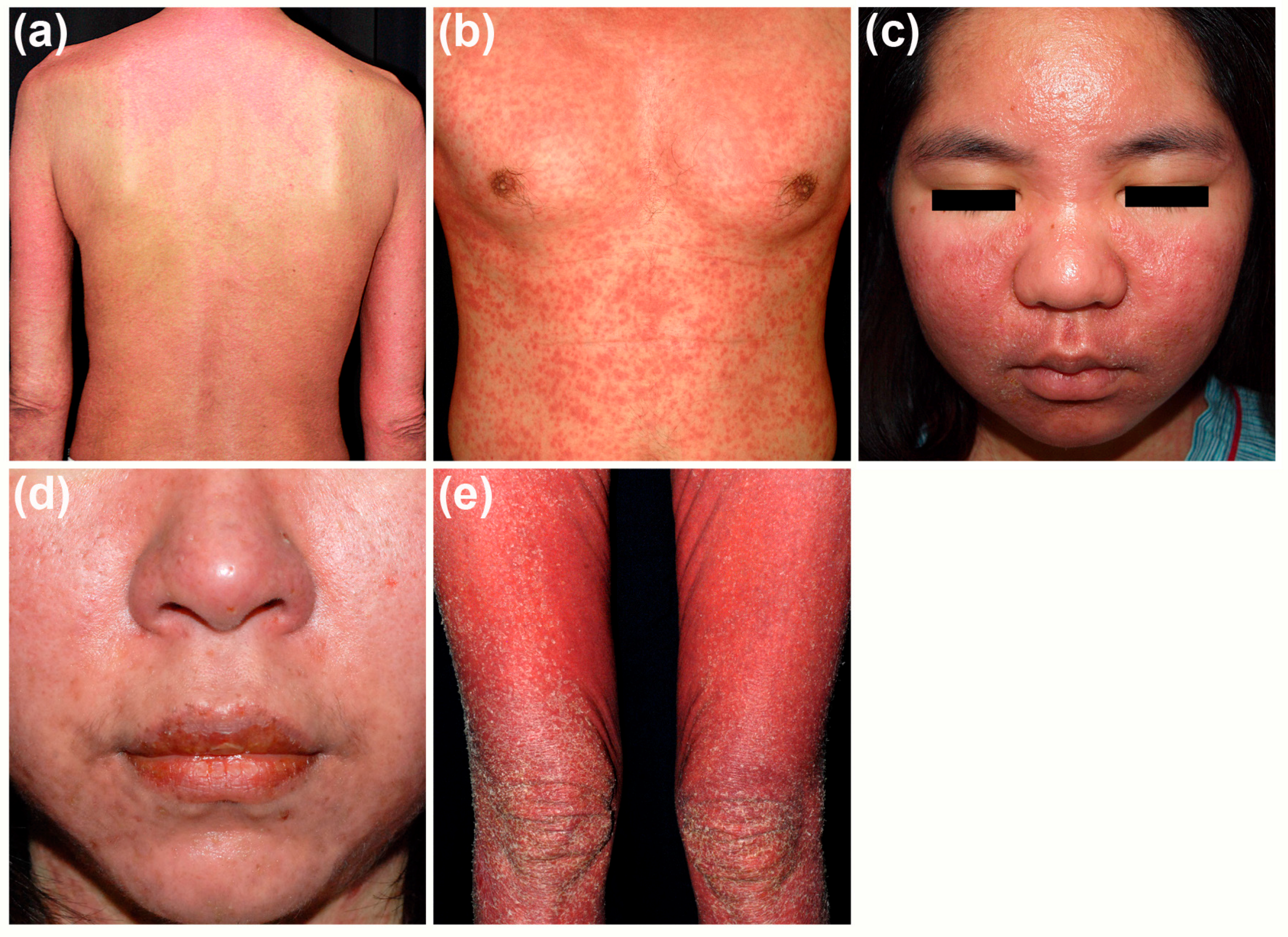 dress eosinophilia and systemic symptoms