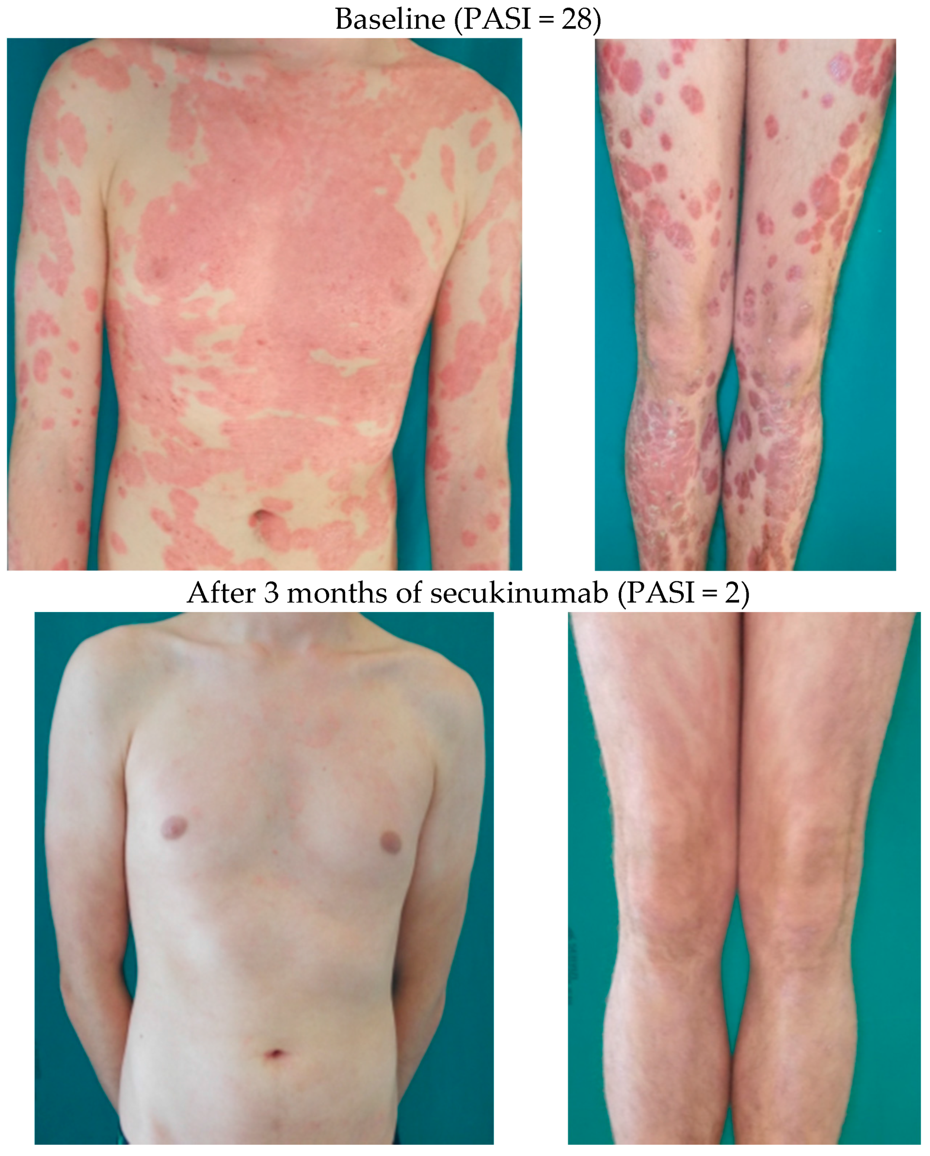 psoriasis after surgery)