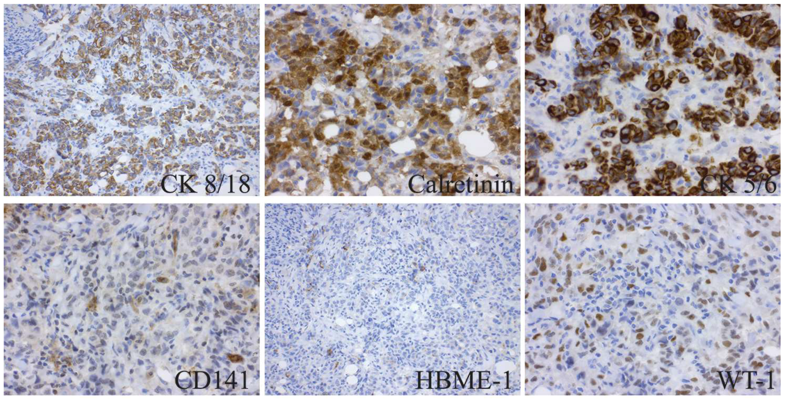 pleural mesothelioma without asbestos exposure